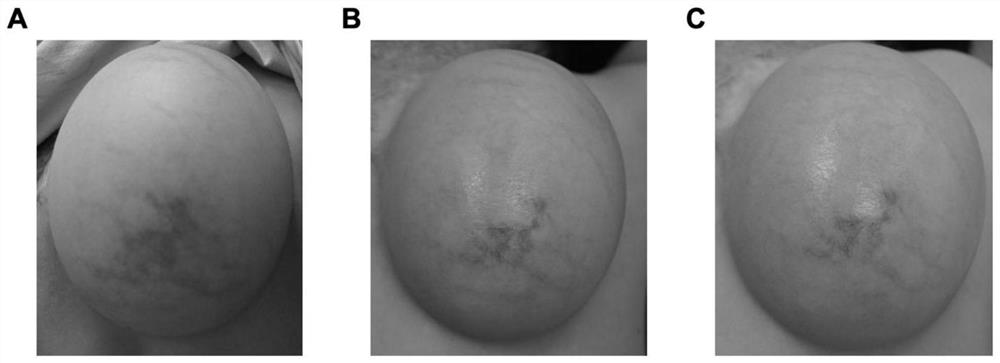 Externally applied medicine for improving blood supply of skin flaps and preparation method of externally applied medicine