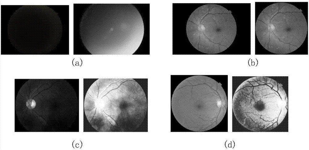 Diabetic retina image automatic classification method