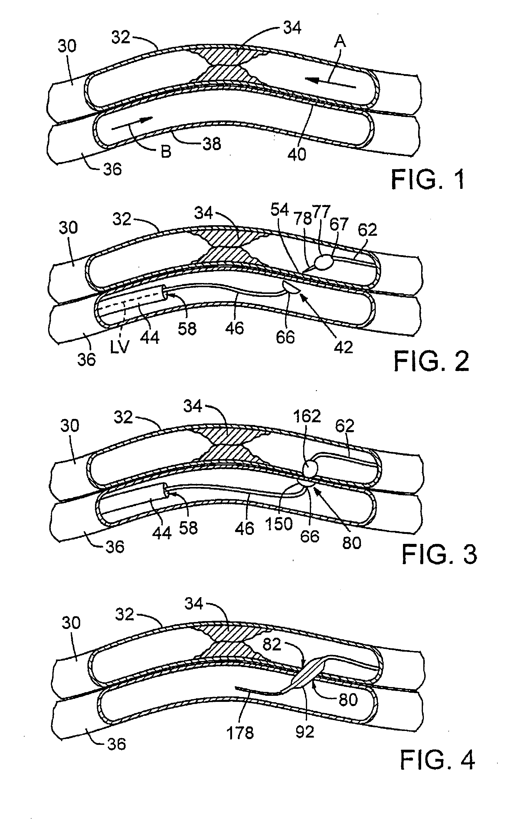 Catheter system with stent apparatus for connecting adjacent blood vessels