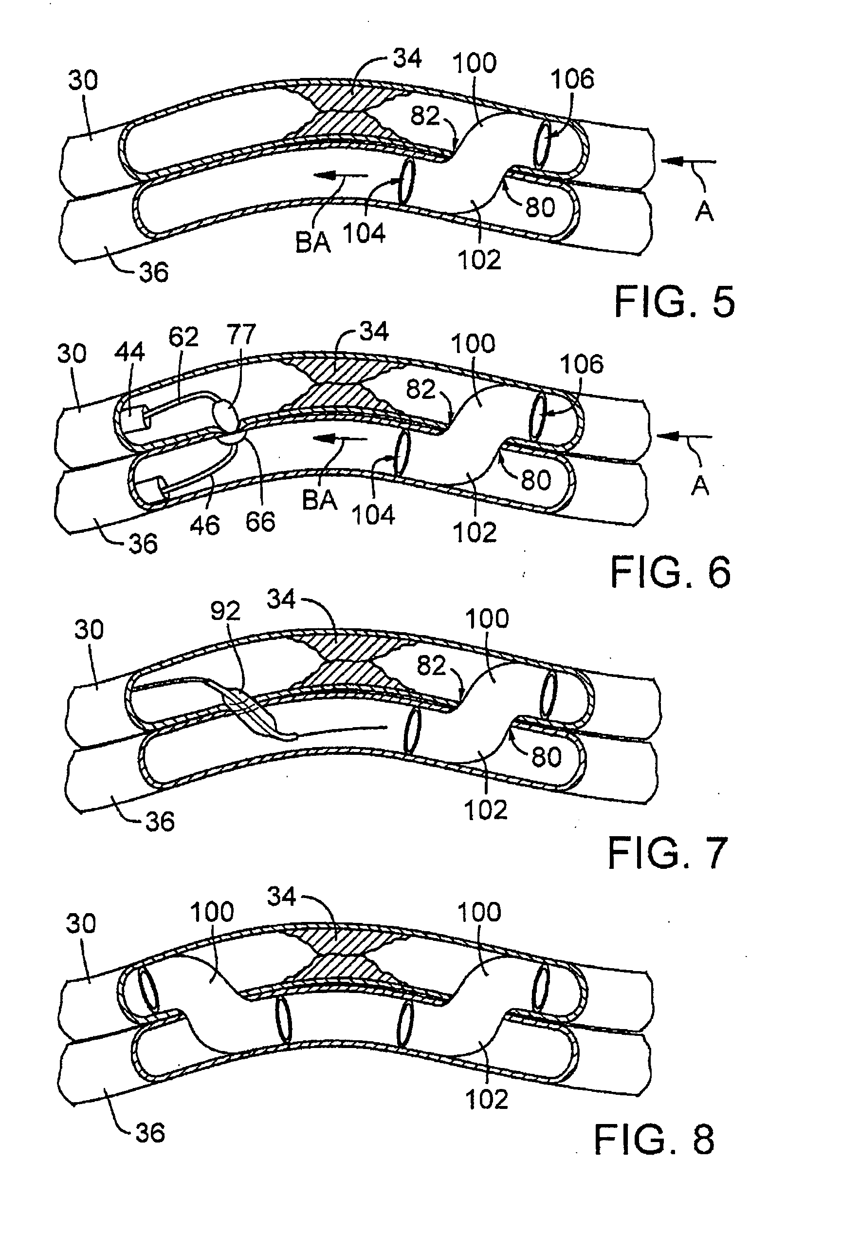 Catheter system with stent apparatus for connecting adjacent blood vessels