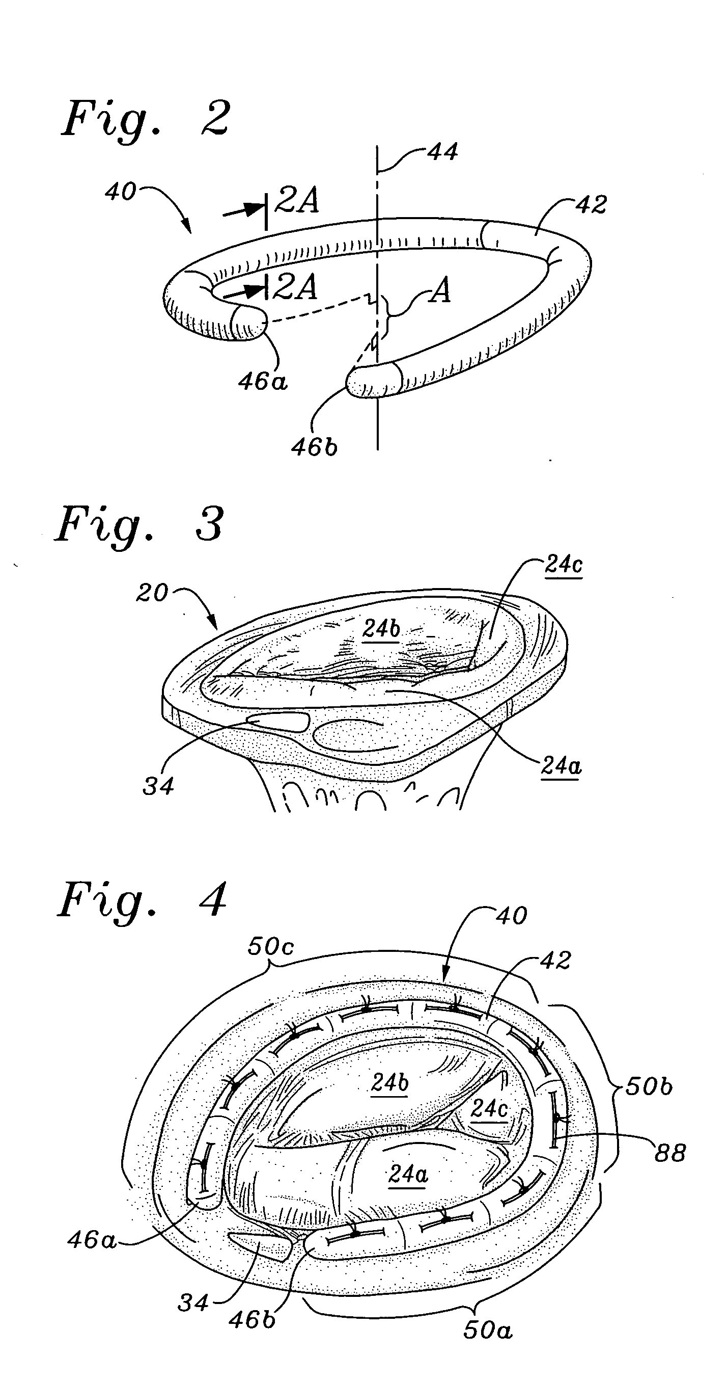 Three-dimensional annuloplasty ring and template