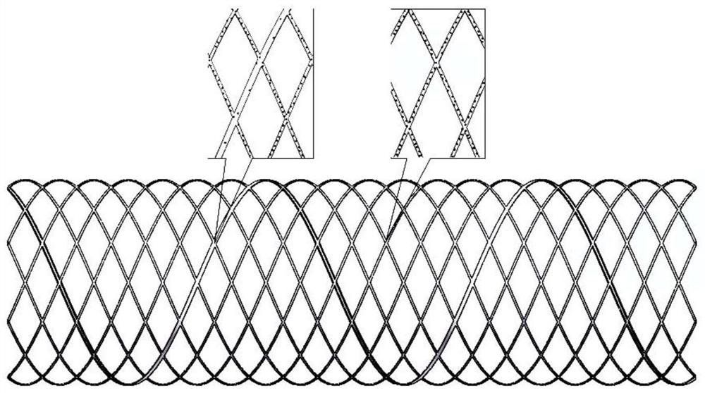 Absorbable intravascular stent and preparation method thereof