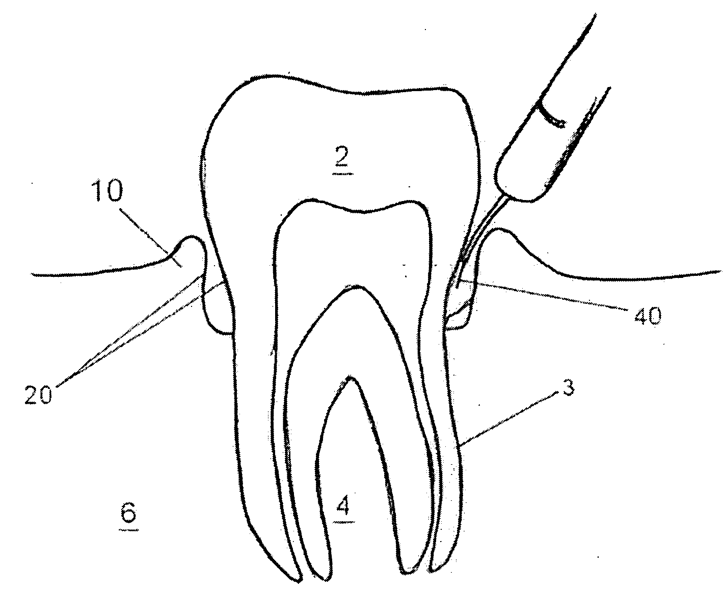 Laser curettage