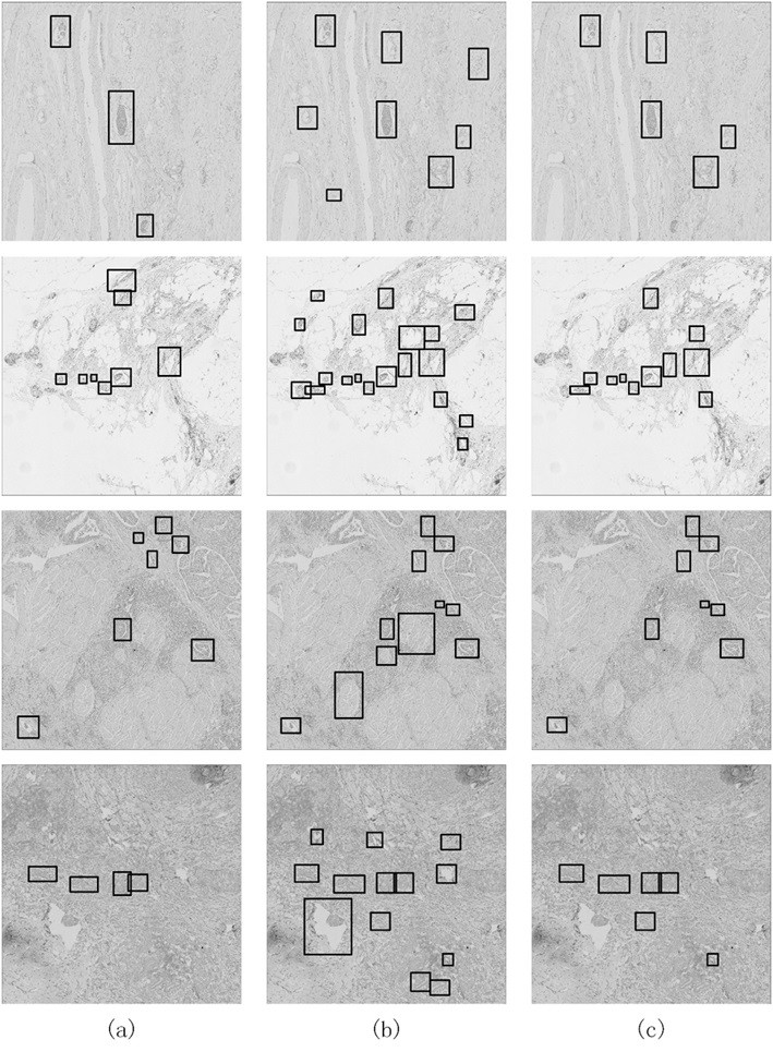 Tumor lymphatic infiltration detection method based on cascade network