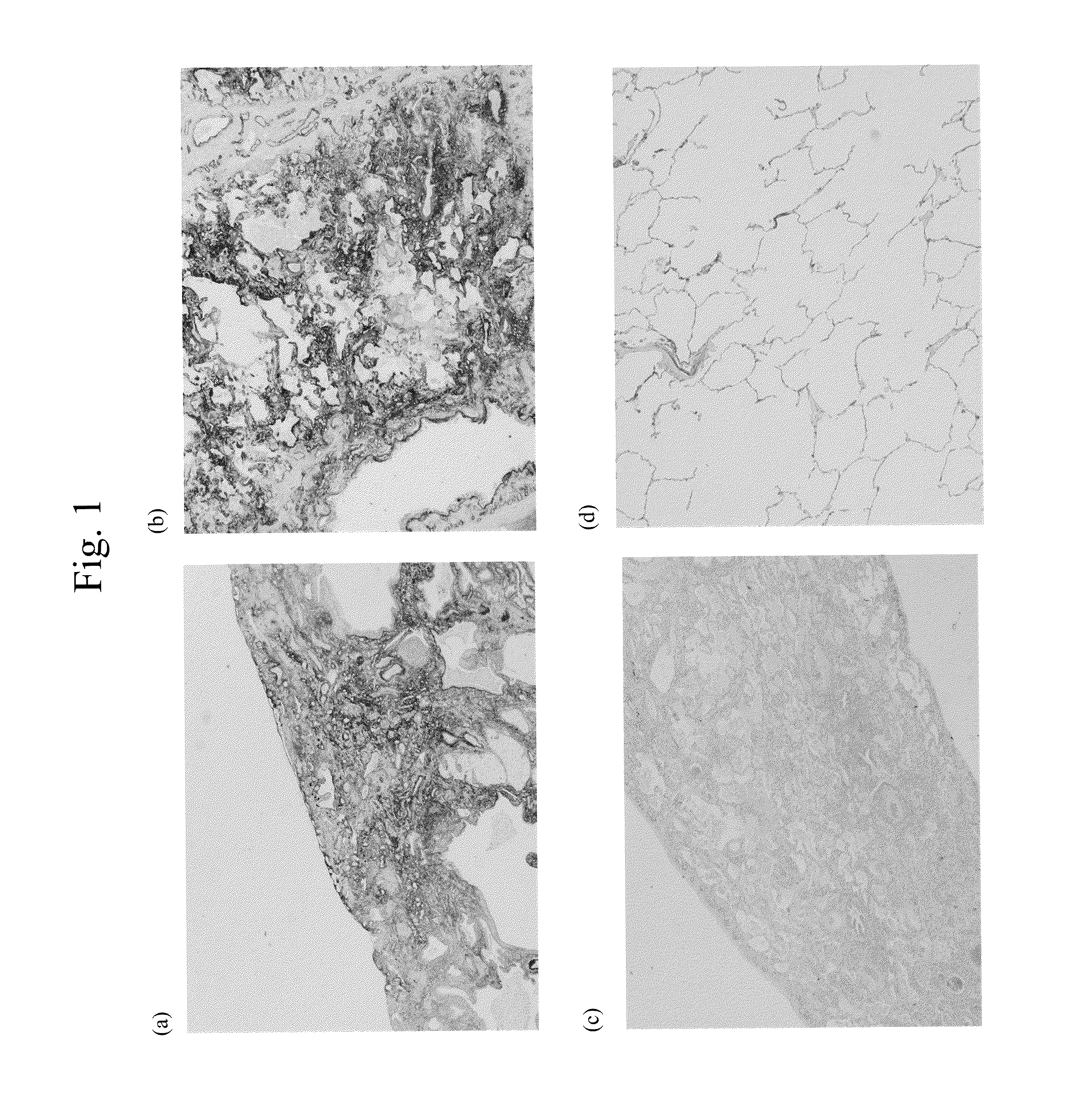 Method for detection of idiopathic interstitial pneumonia