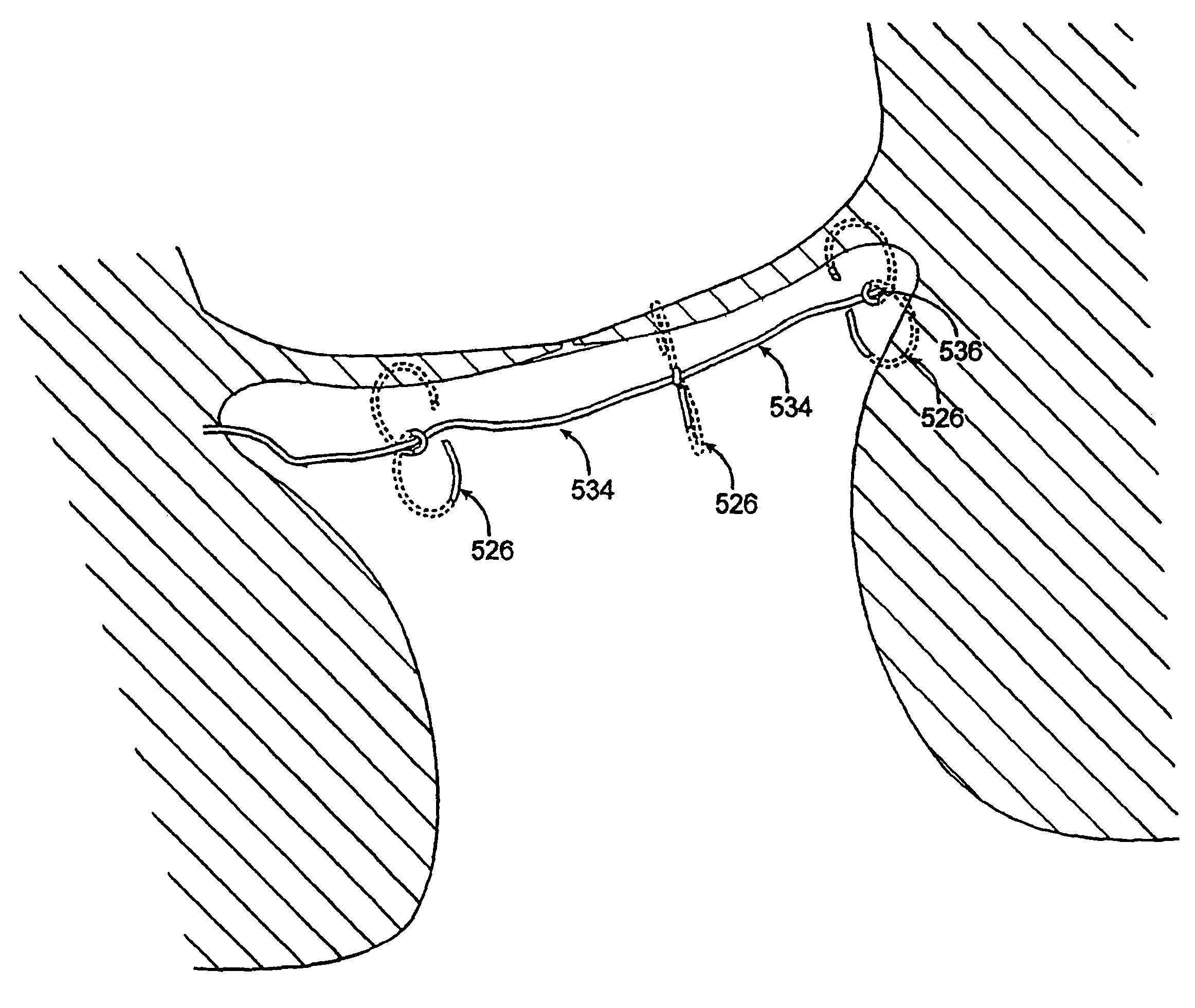 Methods and devices for termination