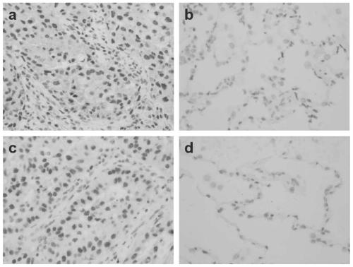 Application of anti-TIF1 gamma-IgA and anti-TIF1 gamma-IgG as combined diagnosis marker in lung cancer diagnosis