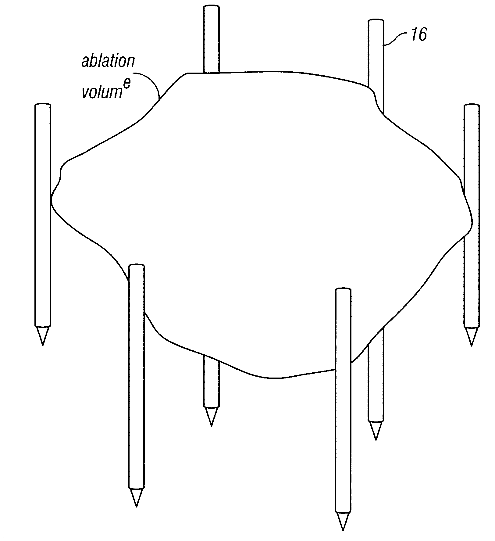 Systems for treating tissue sites using electroporation