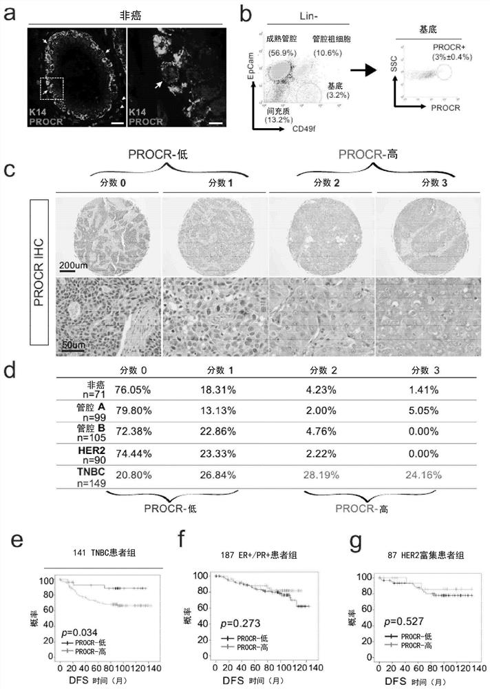 Methods and compositions for tnbc stratification and treatment