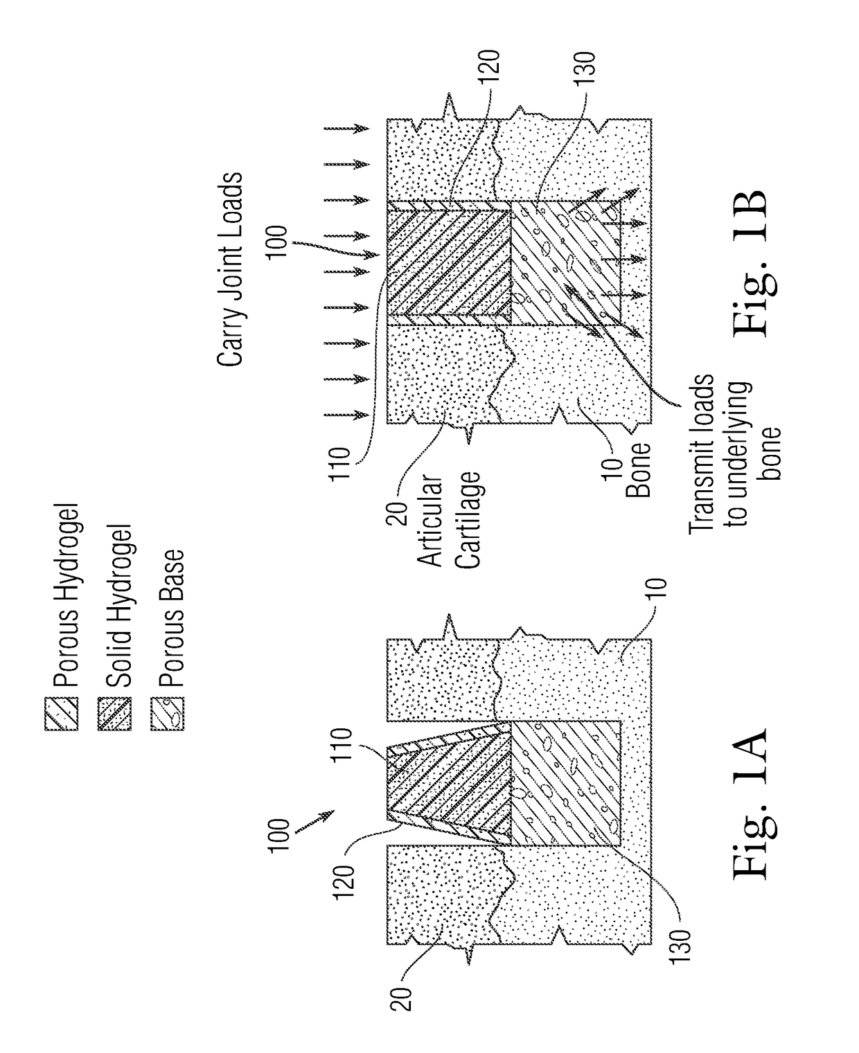 Multi-component non-biodegradable implant, a method of making and a method of implantation