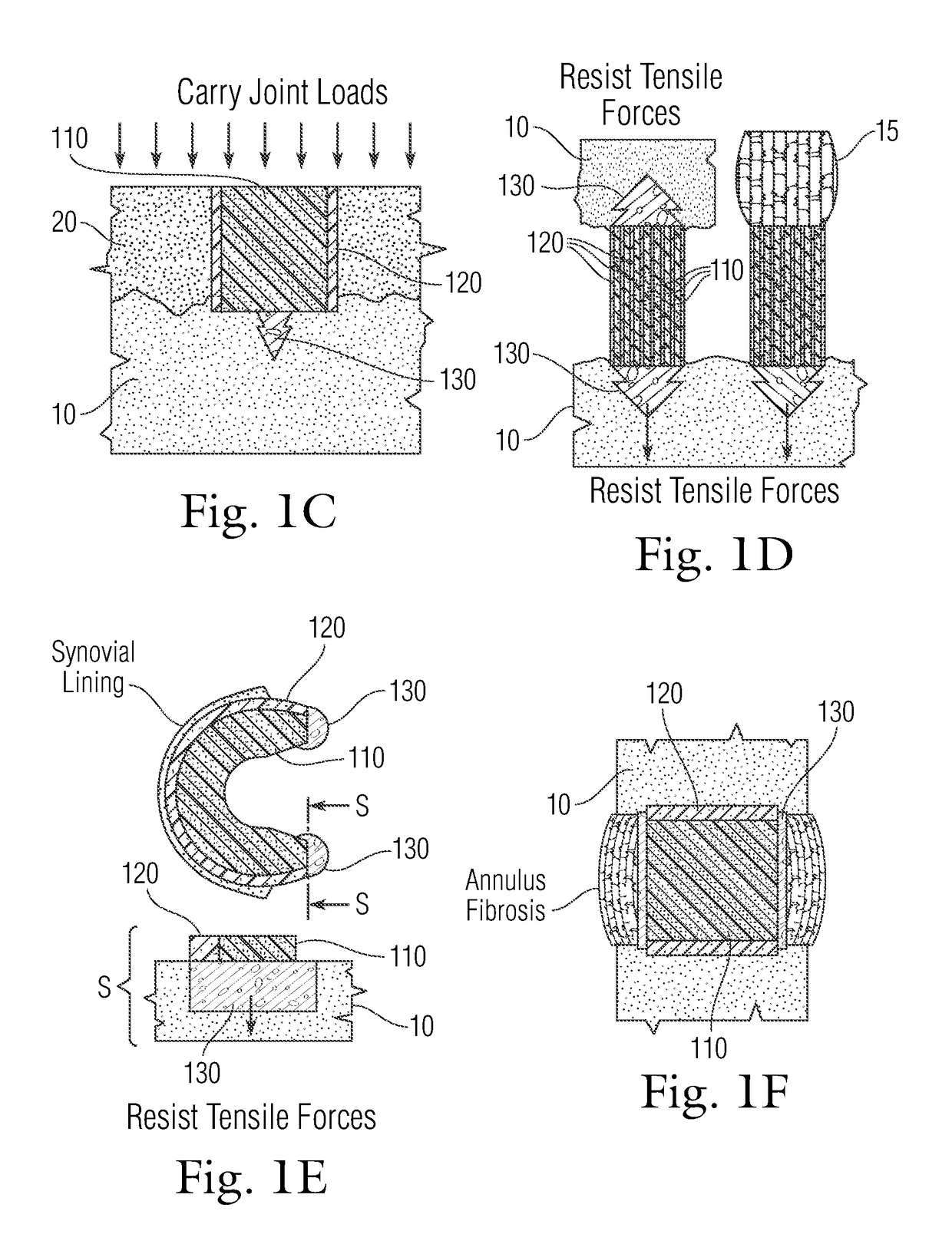 Multi-component non-biodegradable implant, a method of making and a method of implantation