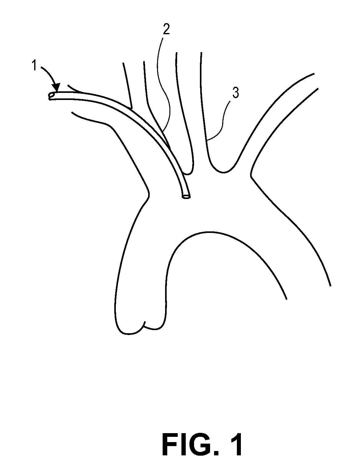 Intravascular Blood Filters and Methods of Use