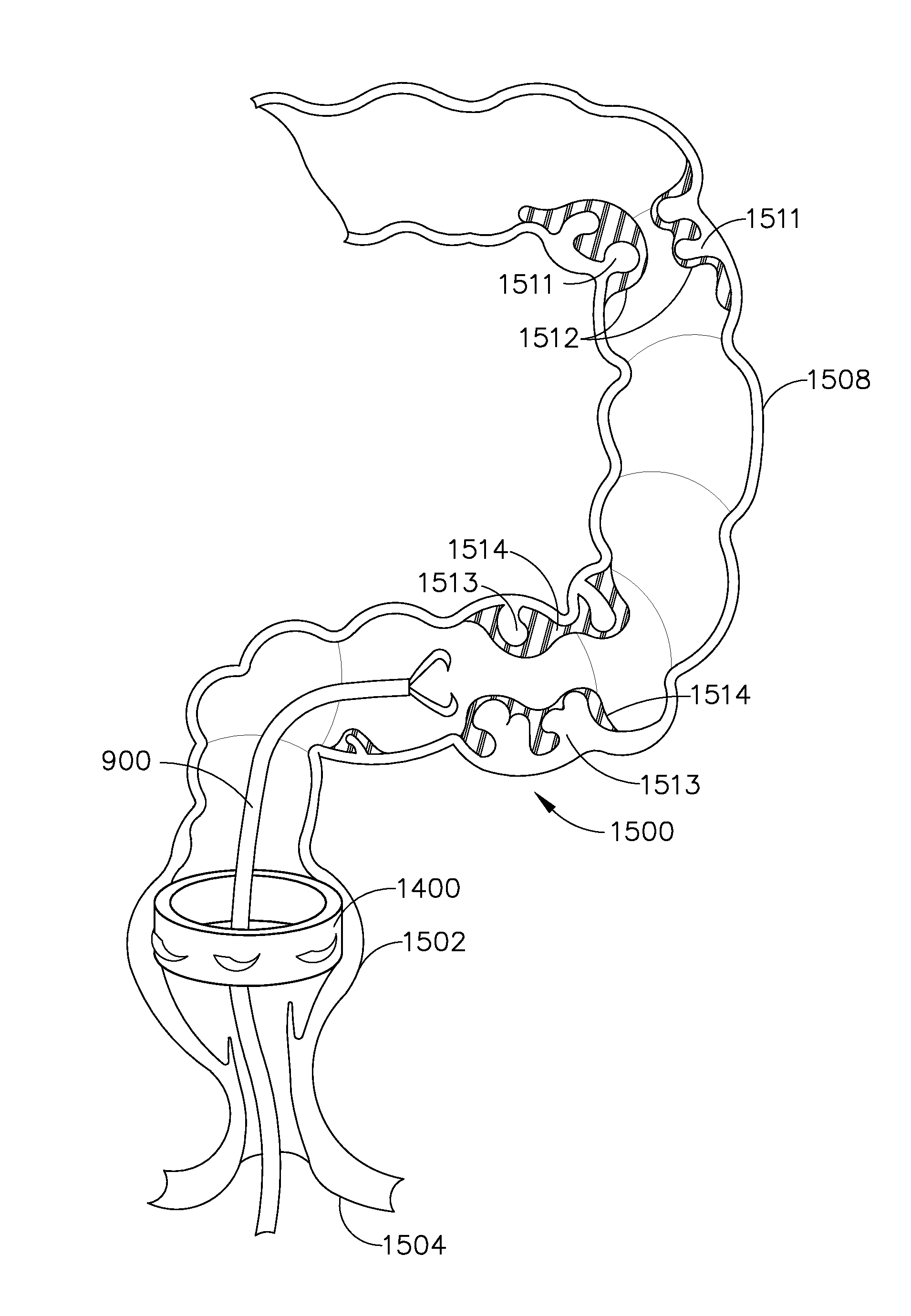 Trans-rectum universal ports