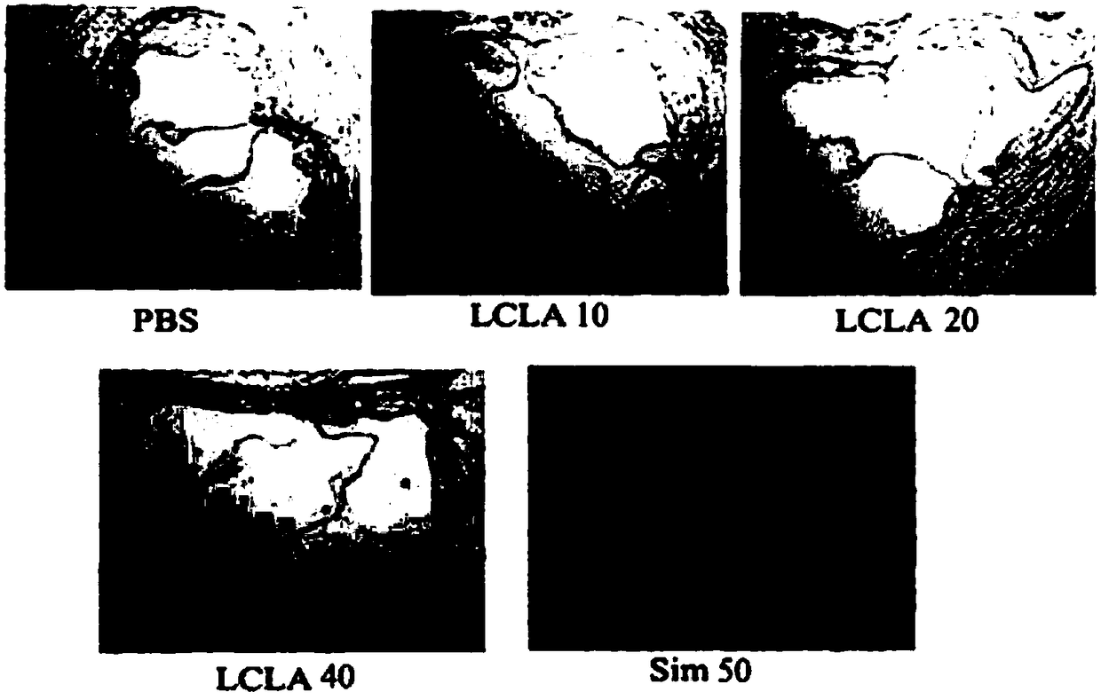 Application of lobelia alkaloids in the preparation of anti-angiogenic disease drugs