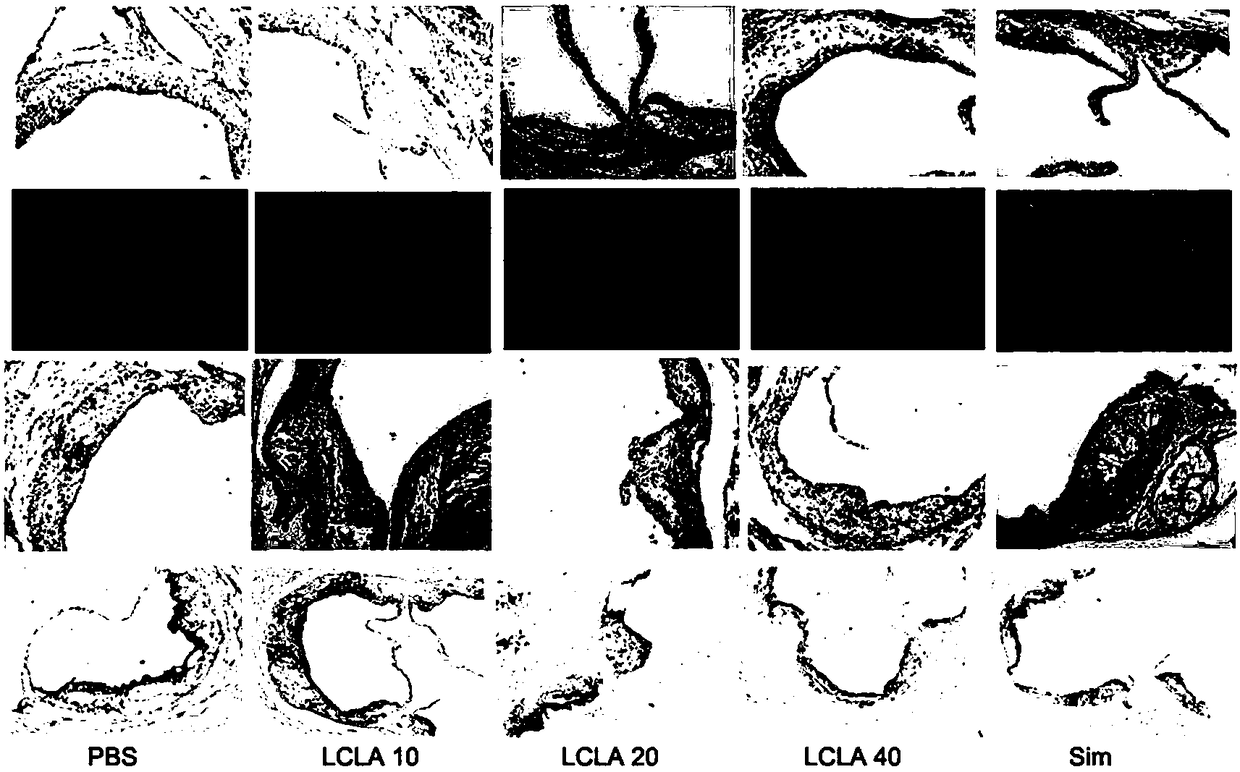 Application of lobelia alkaloids in the preparation of anti-angiogenic disease drugs