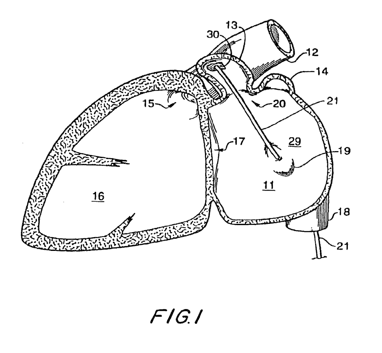 Atrial appendage blood filtration systems