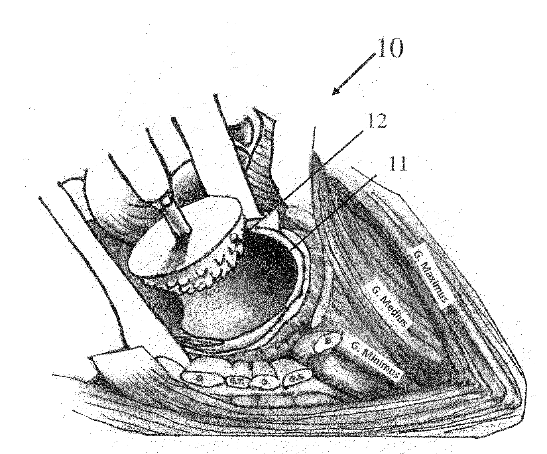 Modular spherical hollow reamer assembly for medical applications