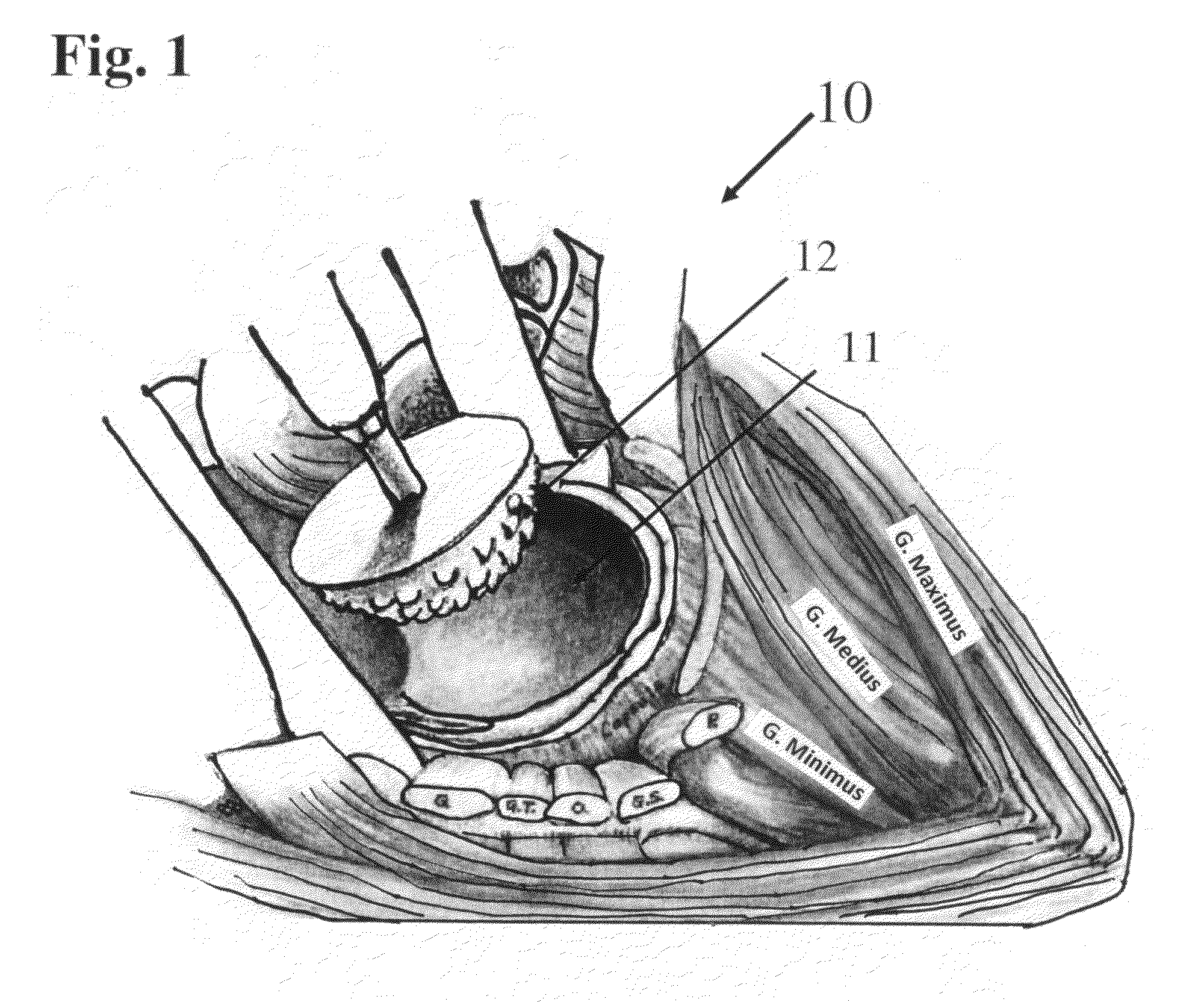 Modular spherical hollow reamer assembly for medical applications