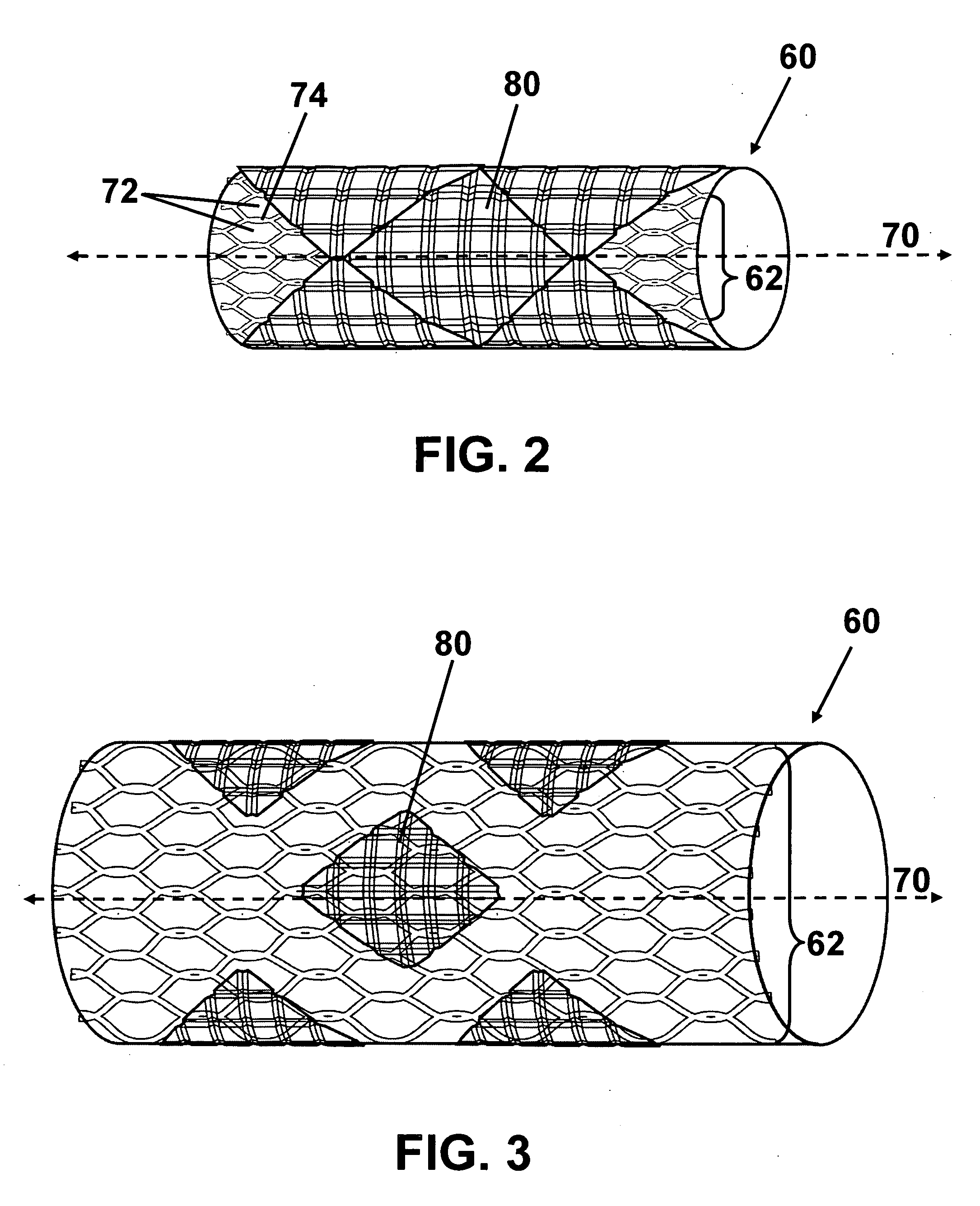 Intraluminal stent including therapeutic agent delivery pads, and method of manufacturing the same