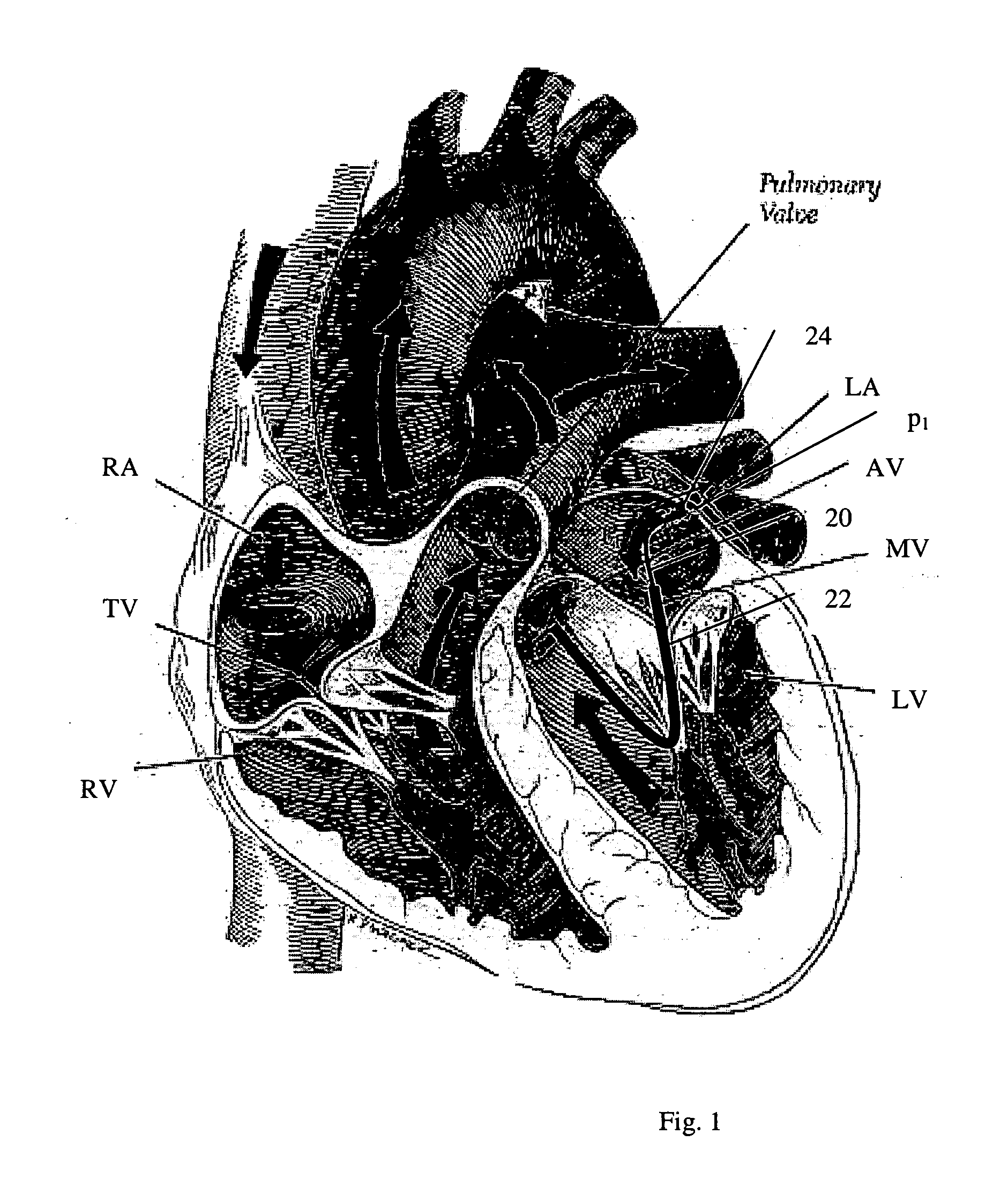 Navigation of remotely actuable medical device using control variable and length