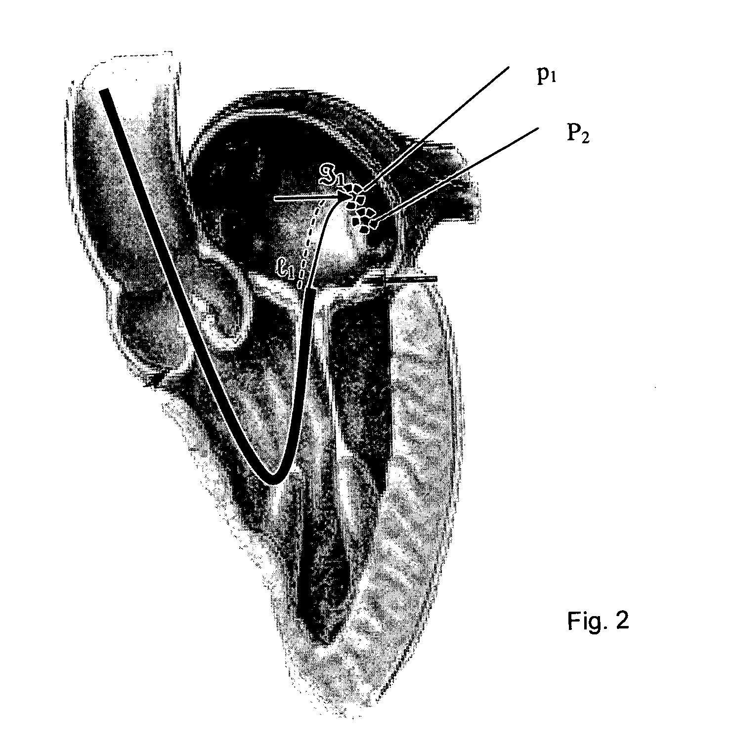 Navigation of remotely actuable medical device using control variable and length