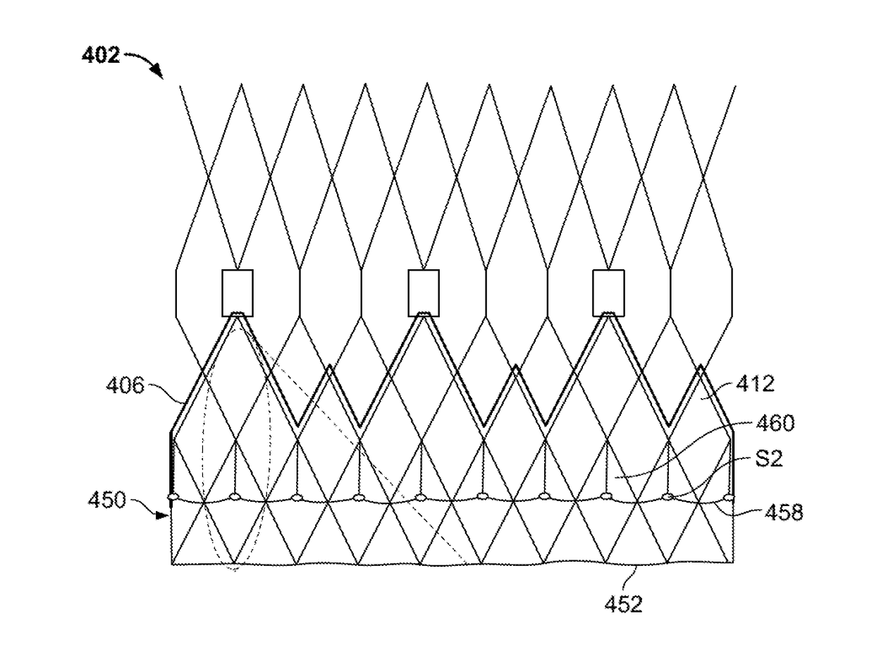 Prosthetic heart valve with paravalvular leak mitigation features