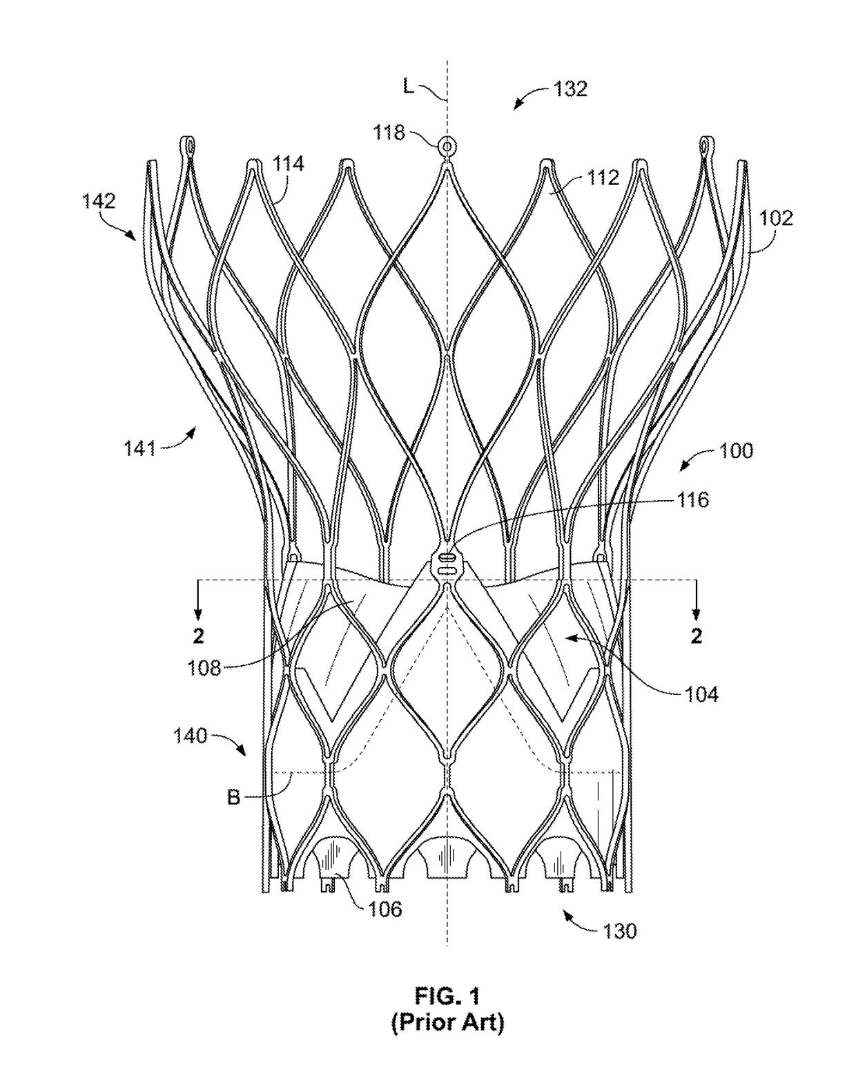 Prosthetic heart valve with paravalvular leak mitigation features