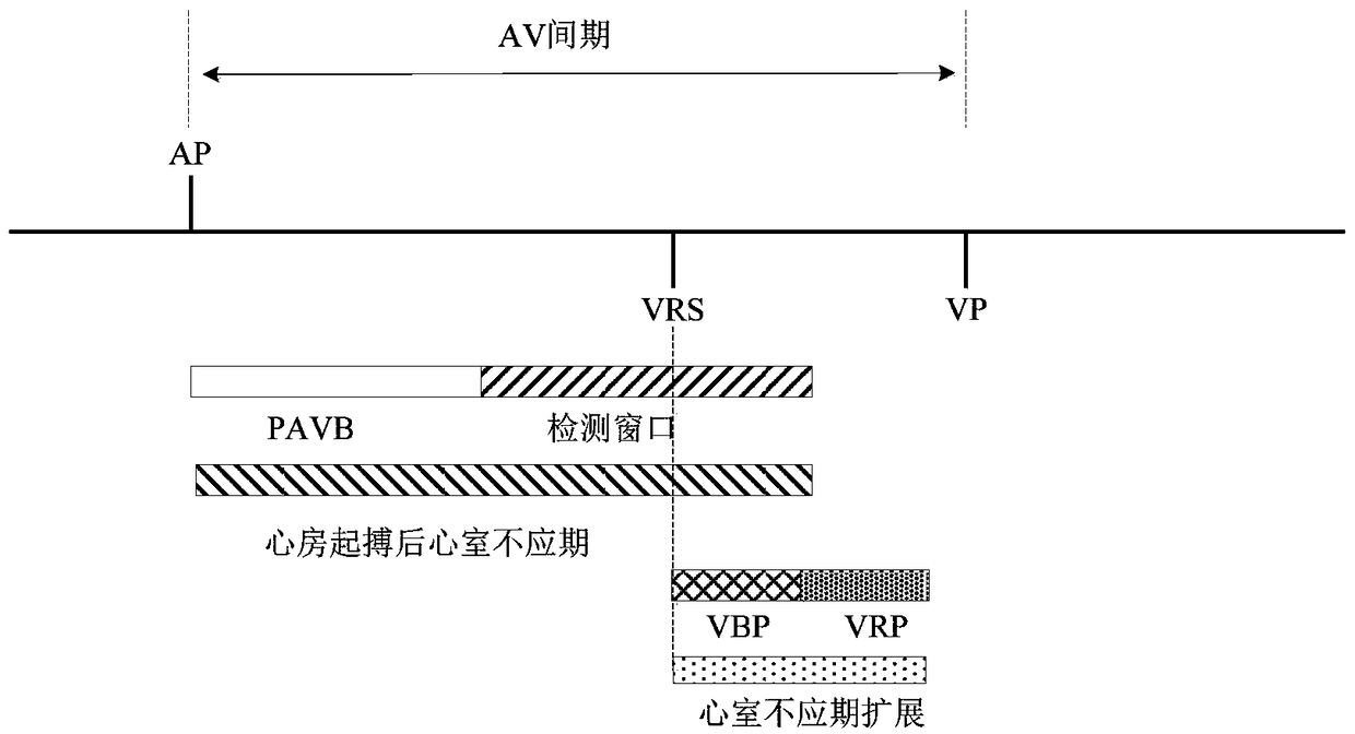 Method for Eliminating High-frequency Interference in Ventricular AV Interval of Implantable Cardiac Pacemaker