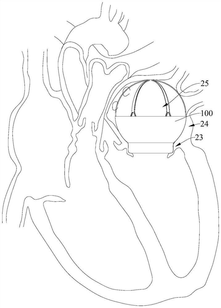 Valve prosthesis and valve prosthesis system