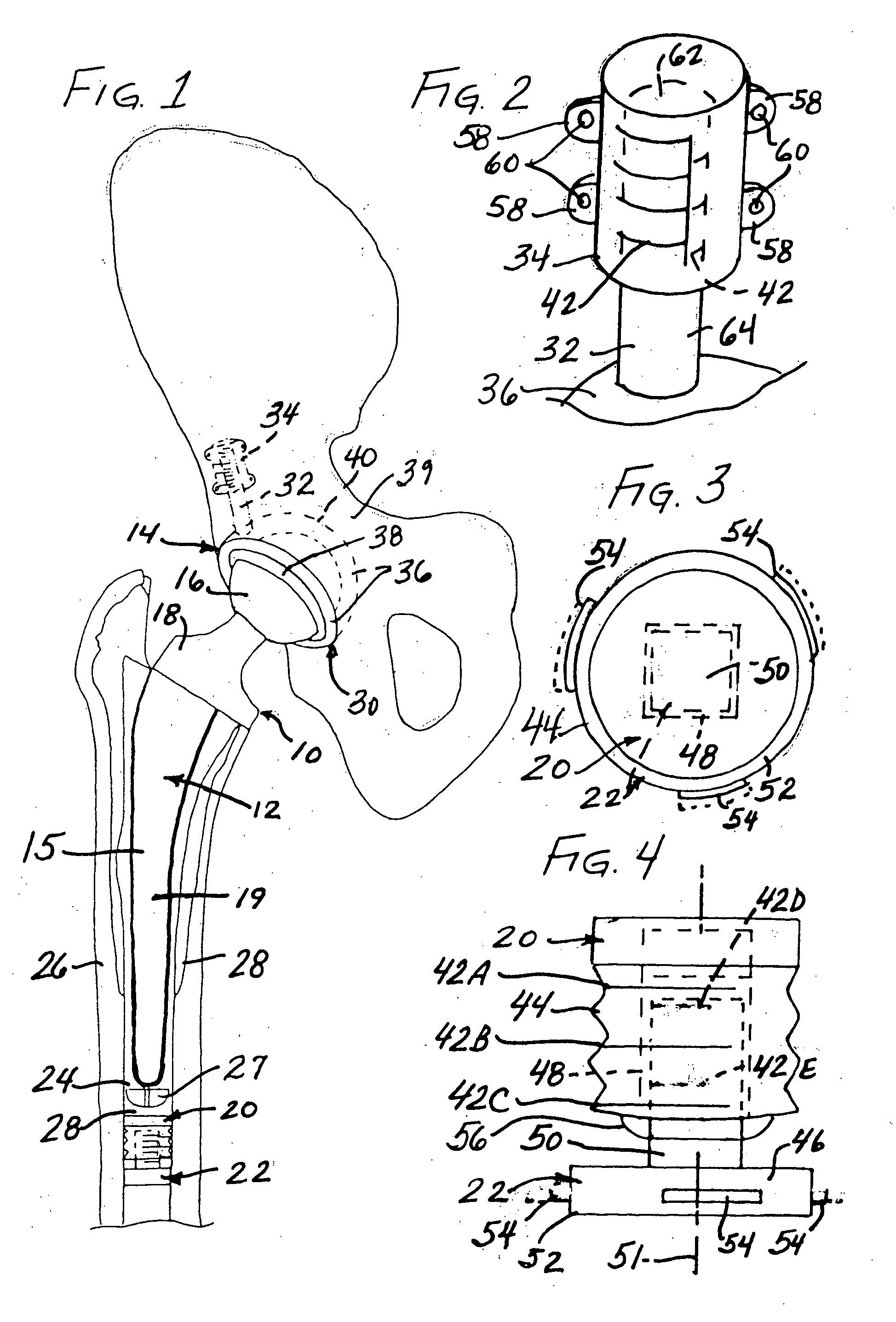 Implant system with migration measurement capacity