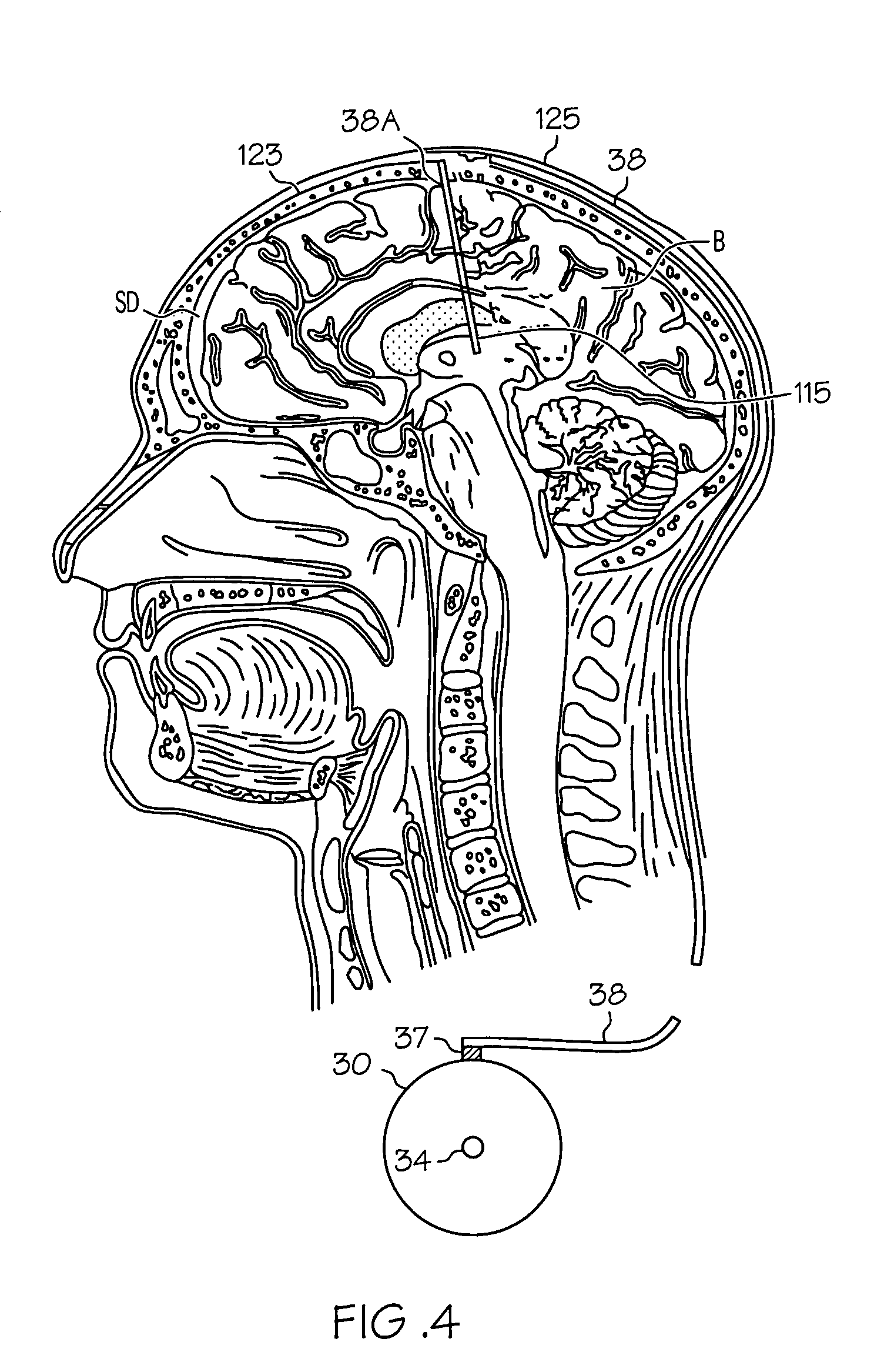 Intrathecal gabapentin for treatment of epilepsy