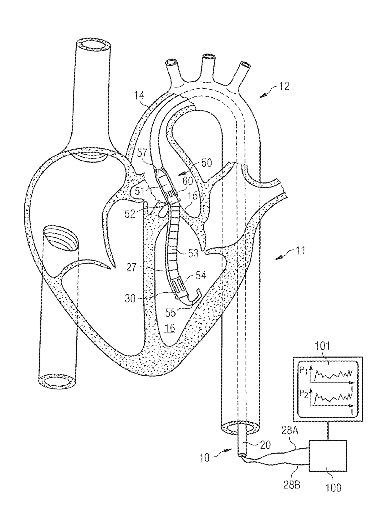 Catheter system and intravascular blood pump comprising said catheter system