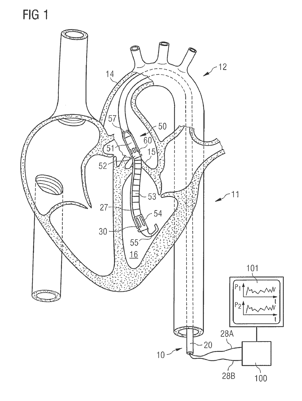 Catheter system and intravascular blood pump comprising said catheter system