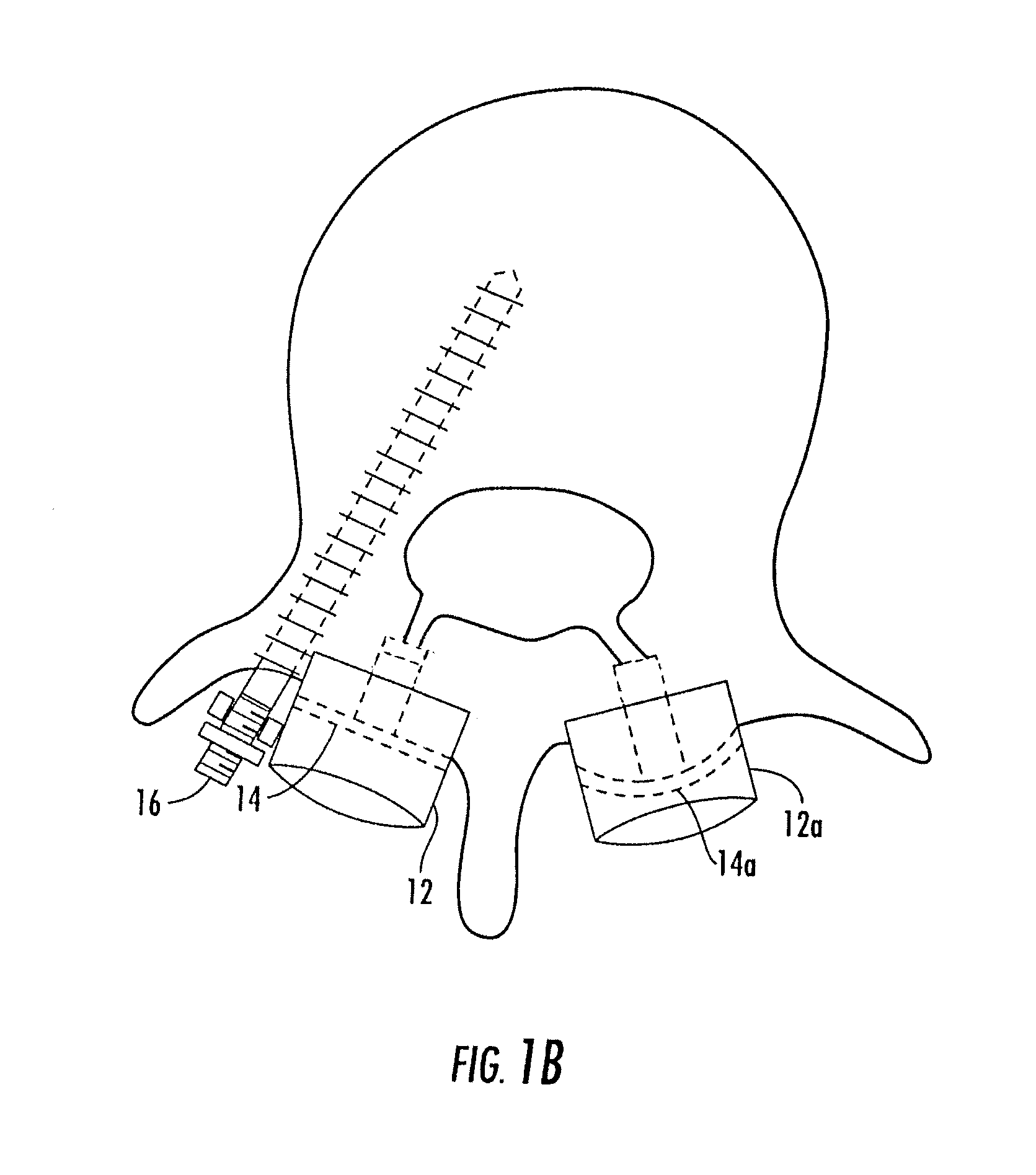 Facet joint fusion device and method for using same