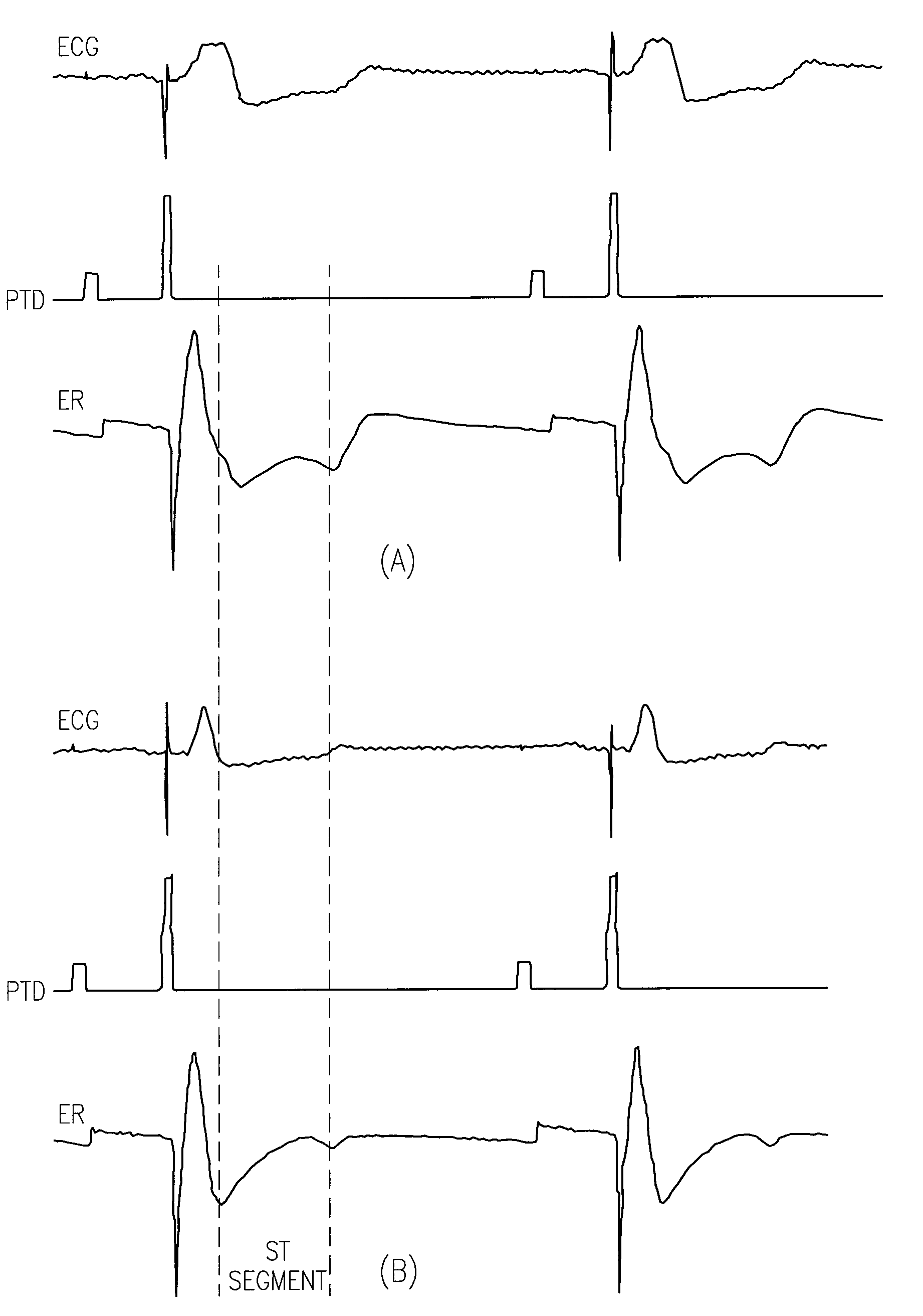 Evoked response sensing for ischemia detection