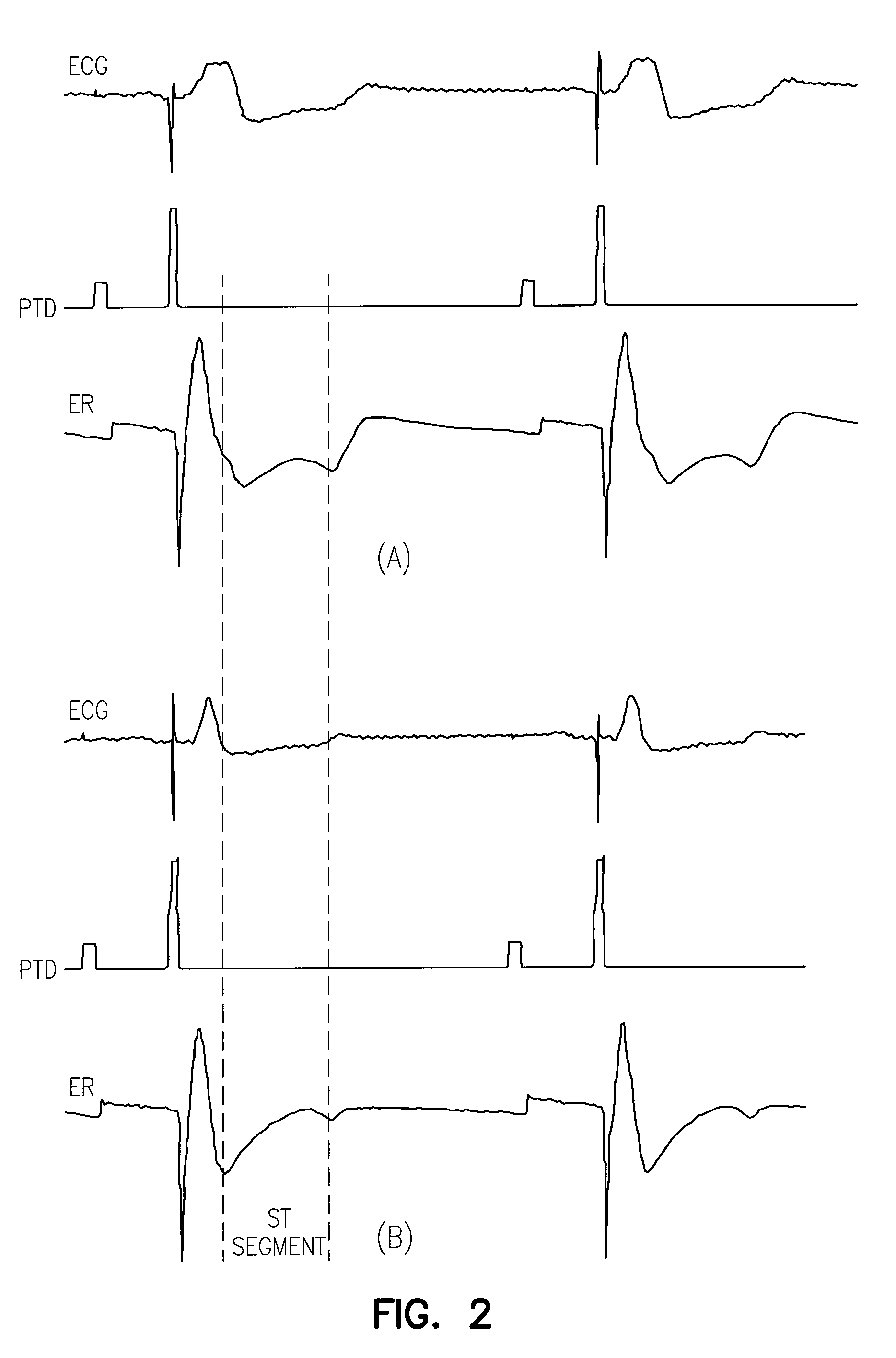 Evoked response sensing for ischemia detection