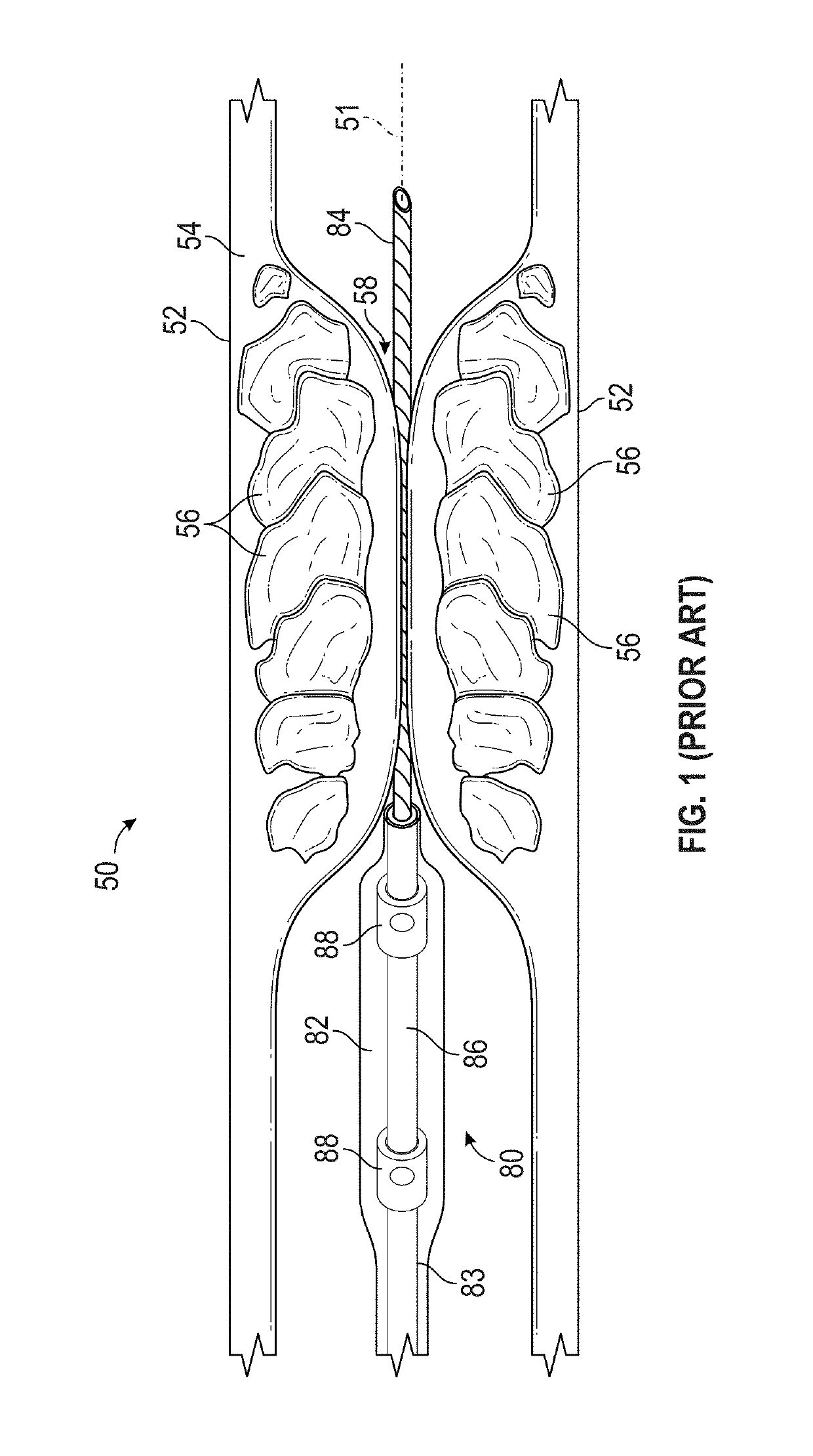 Shock wave balloon catheter with insertable electrodes