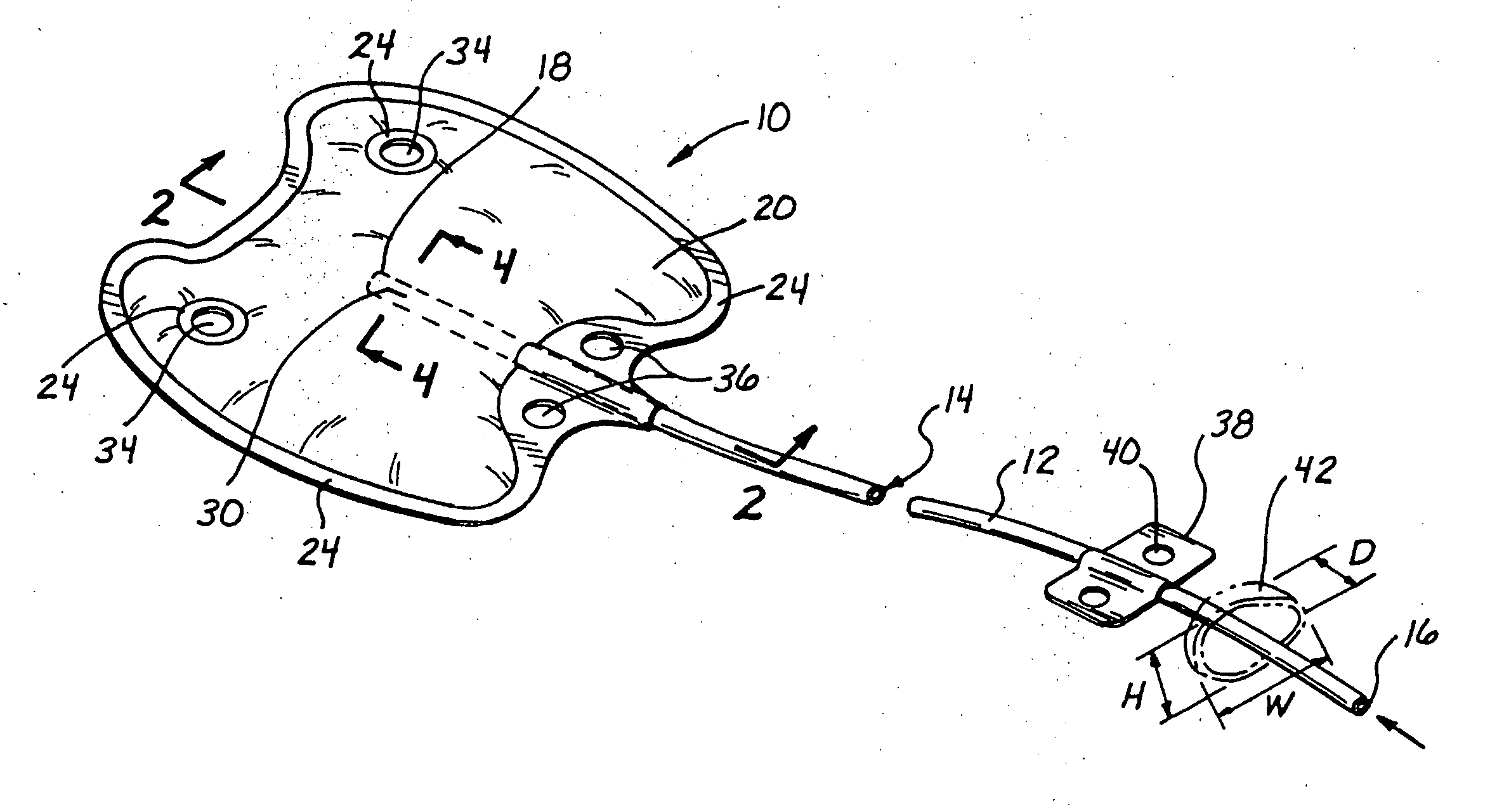 Sutureless implantable device and method for treatment of glaucoma