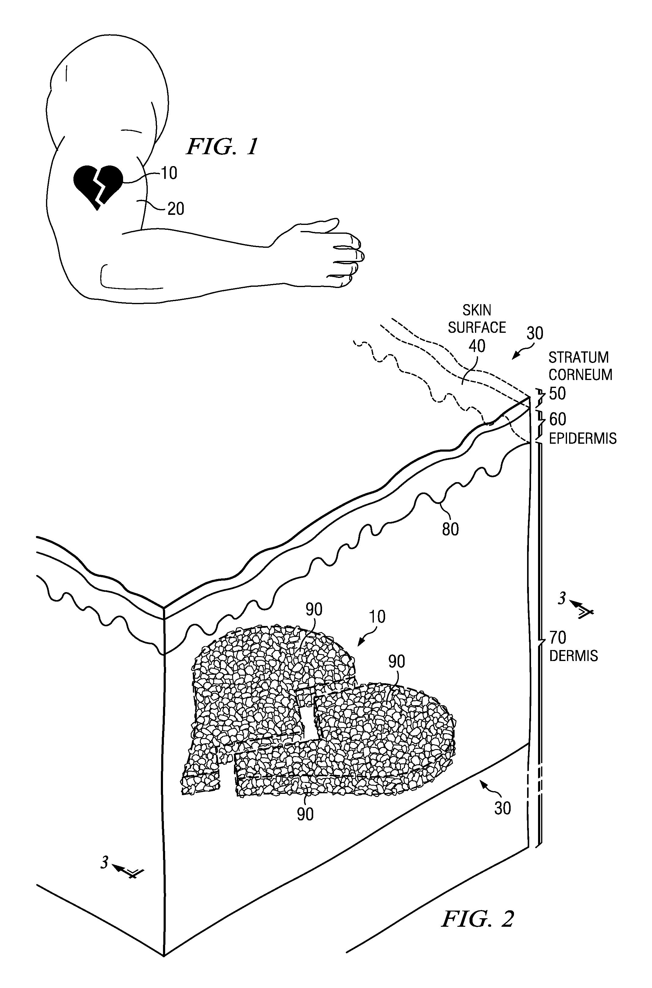 Tattoo Removal System and Method