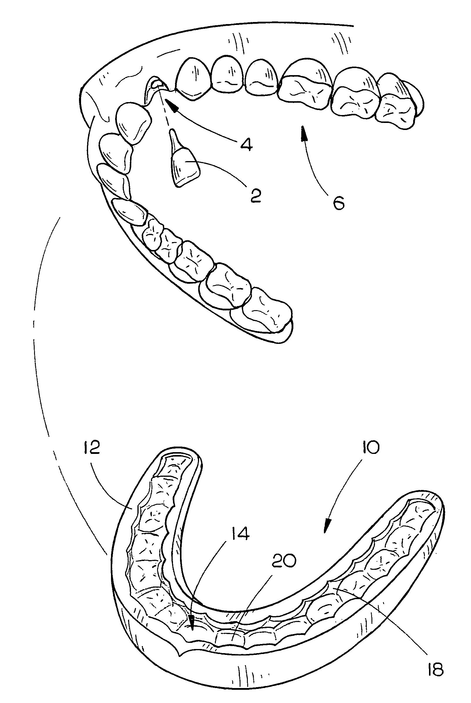 System and method for reimplanting avulsed teeth