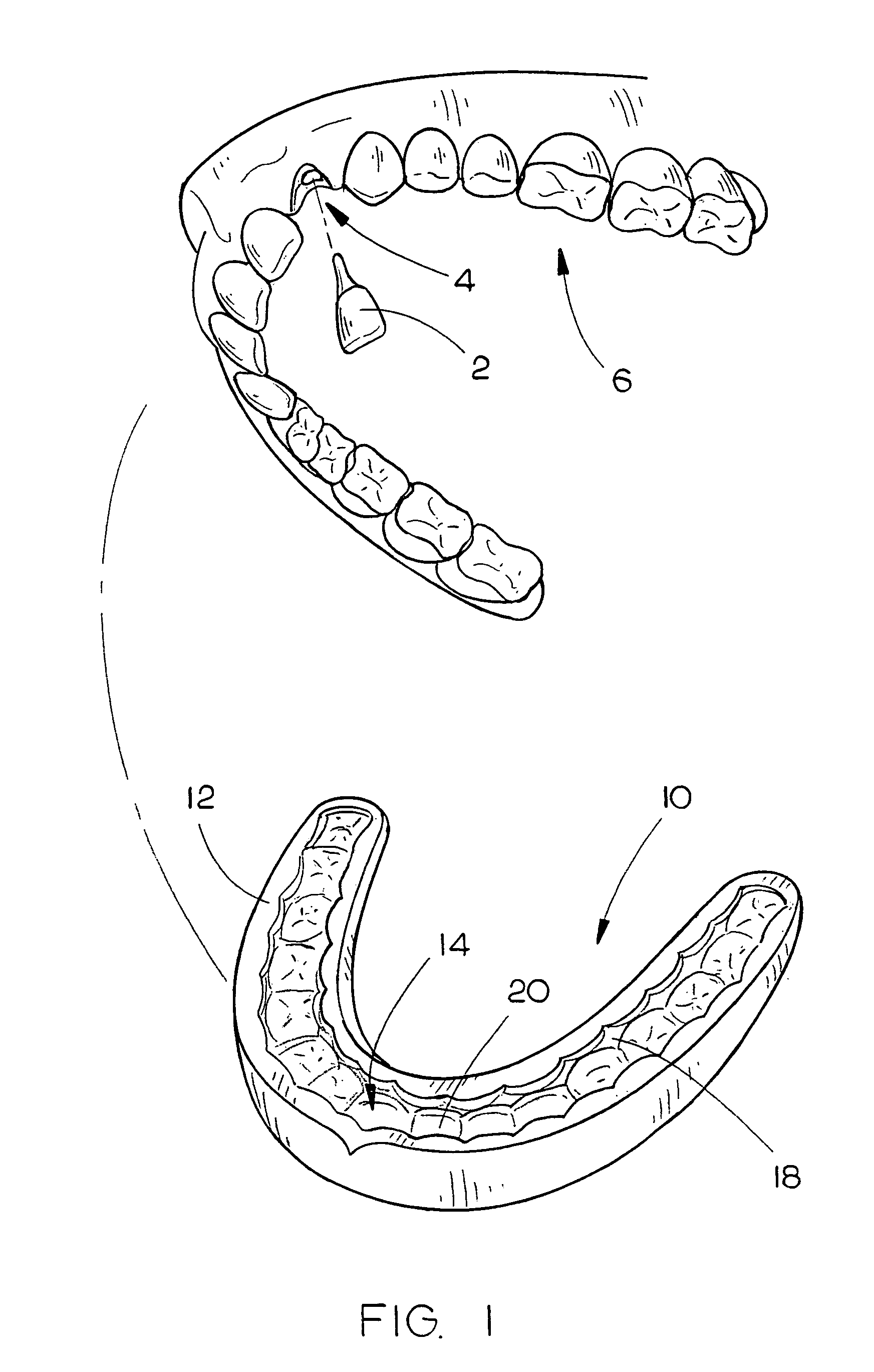 System and method for reimplanting avulsed teeth