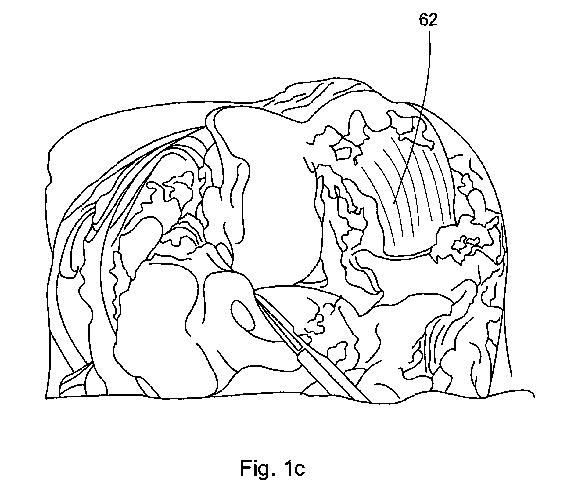 Tibial prosthetic component for a partial or unicondylar bearing knee replacement, method of selecting such a tibial prosthetic component, method of implanting such a tibial prosthetic component and a kit for a surgeon