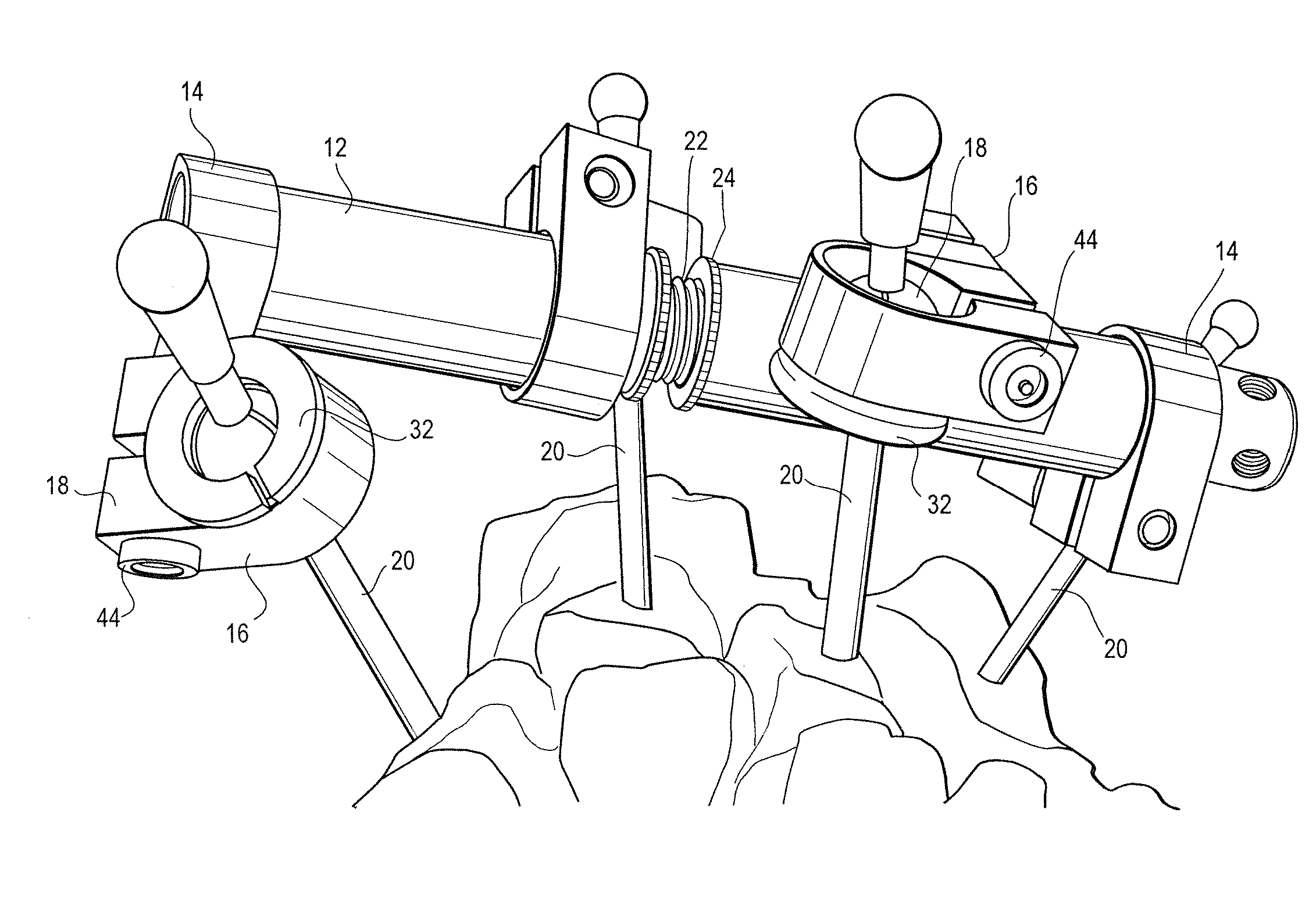 External Bone Fixation System