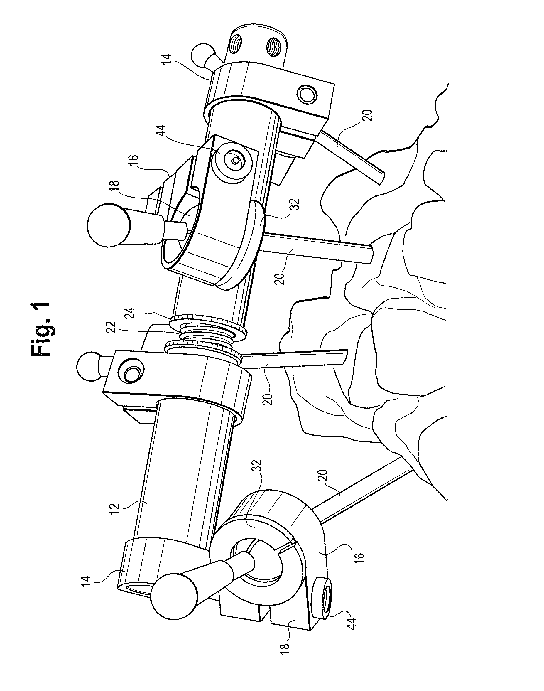 External Bone Fixation System