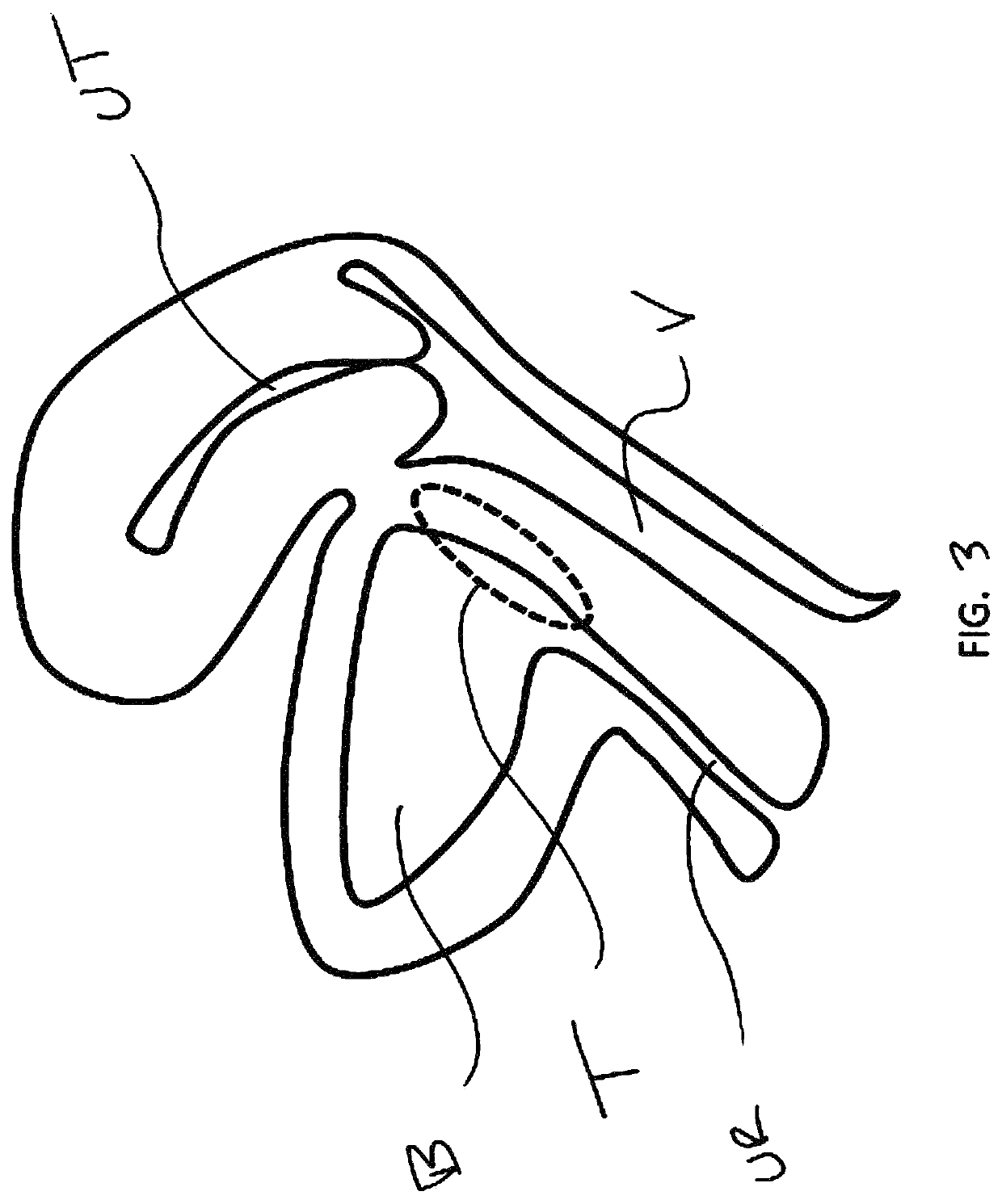 Devices and methods for treating conditions caused by affarent nerve signals