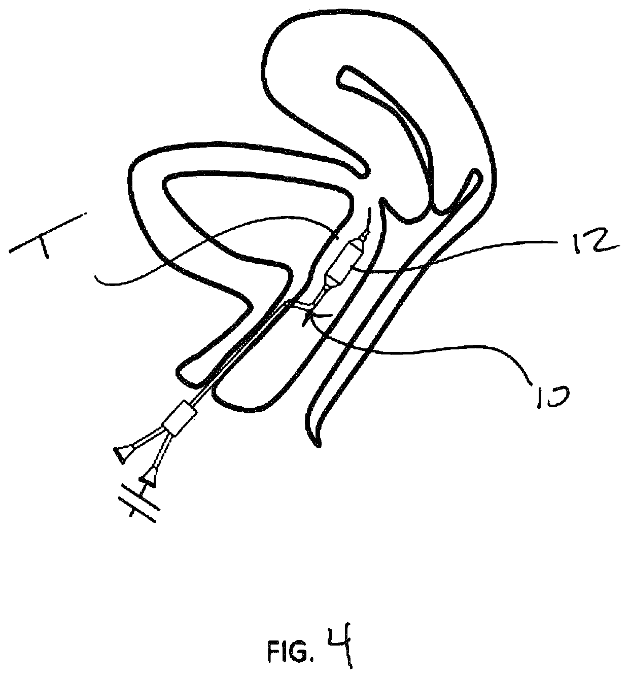 Devices and methods for treating conditions caused by affarent nerve signals