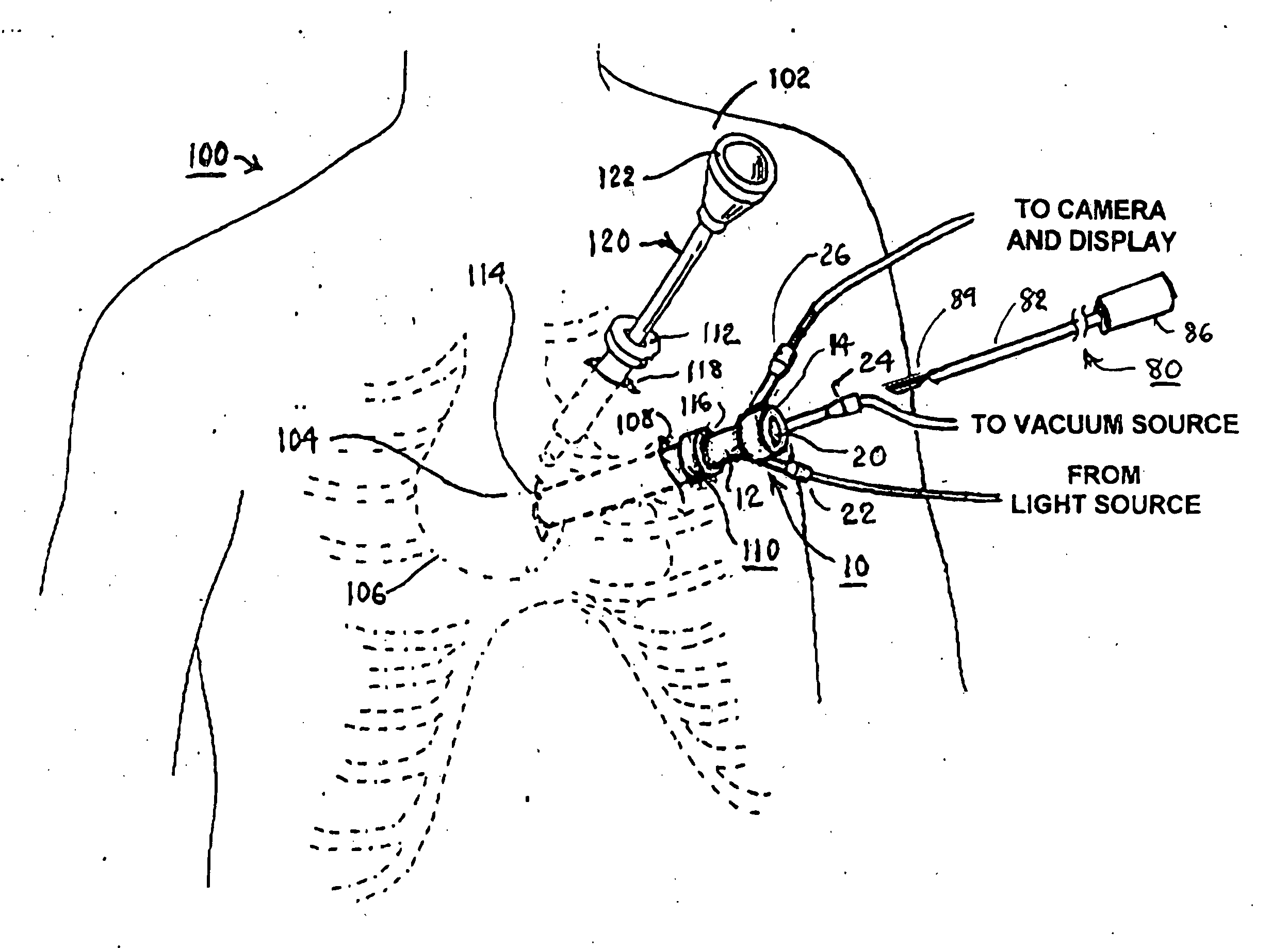 Methods and apparatus for accessing and stabilizing an area of the heart