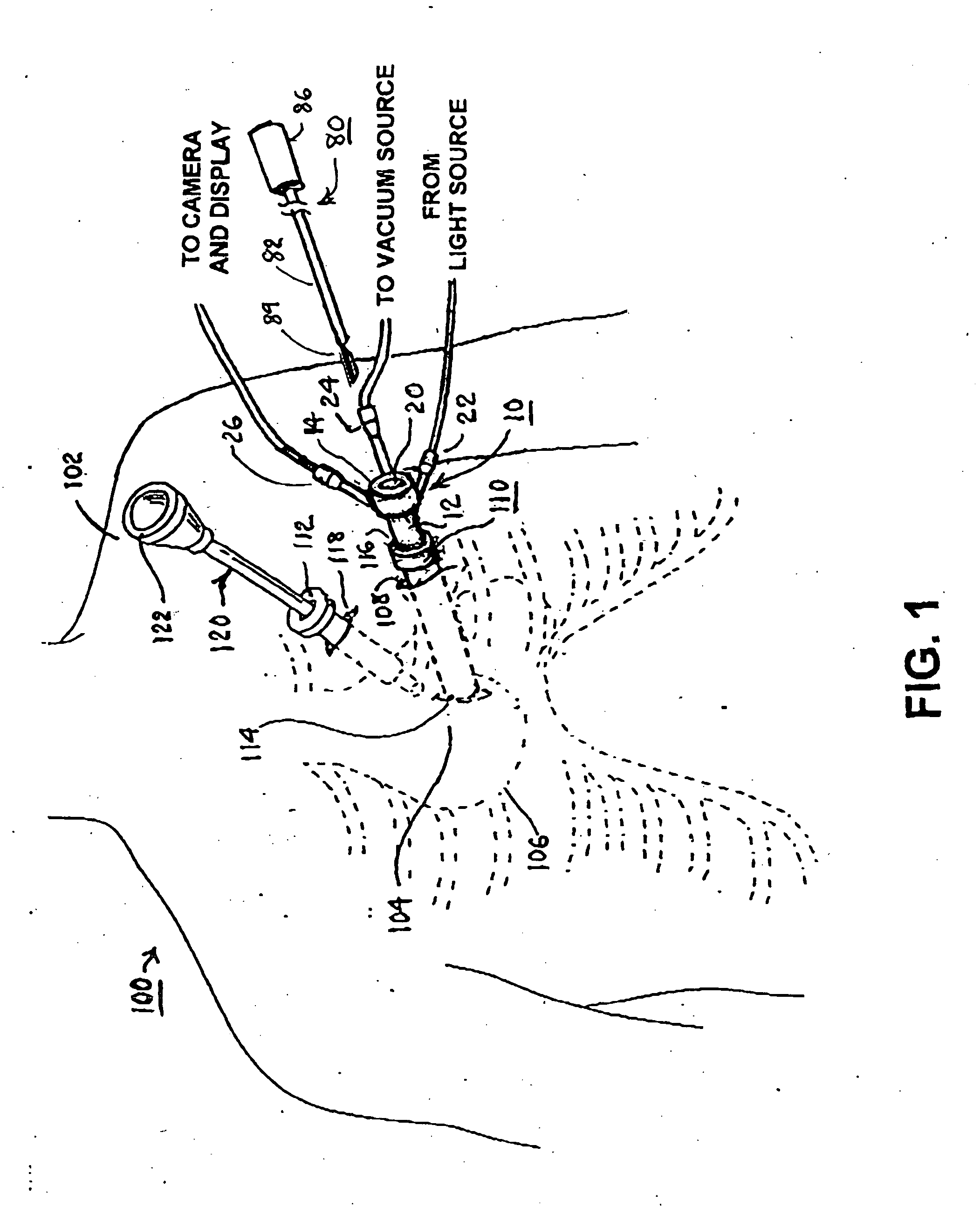 Methods and apparatus for accessing and stabilizing an area of the heart