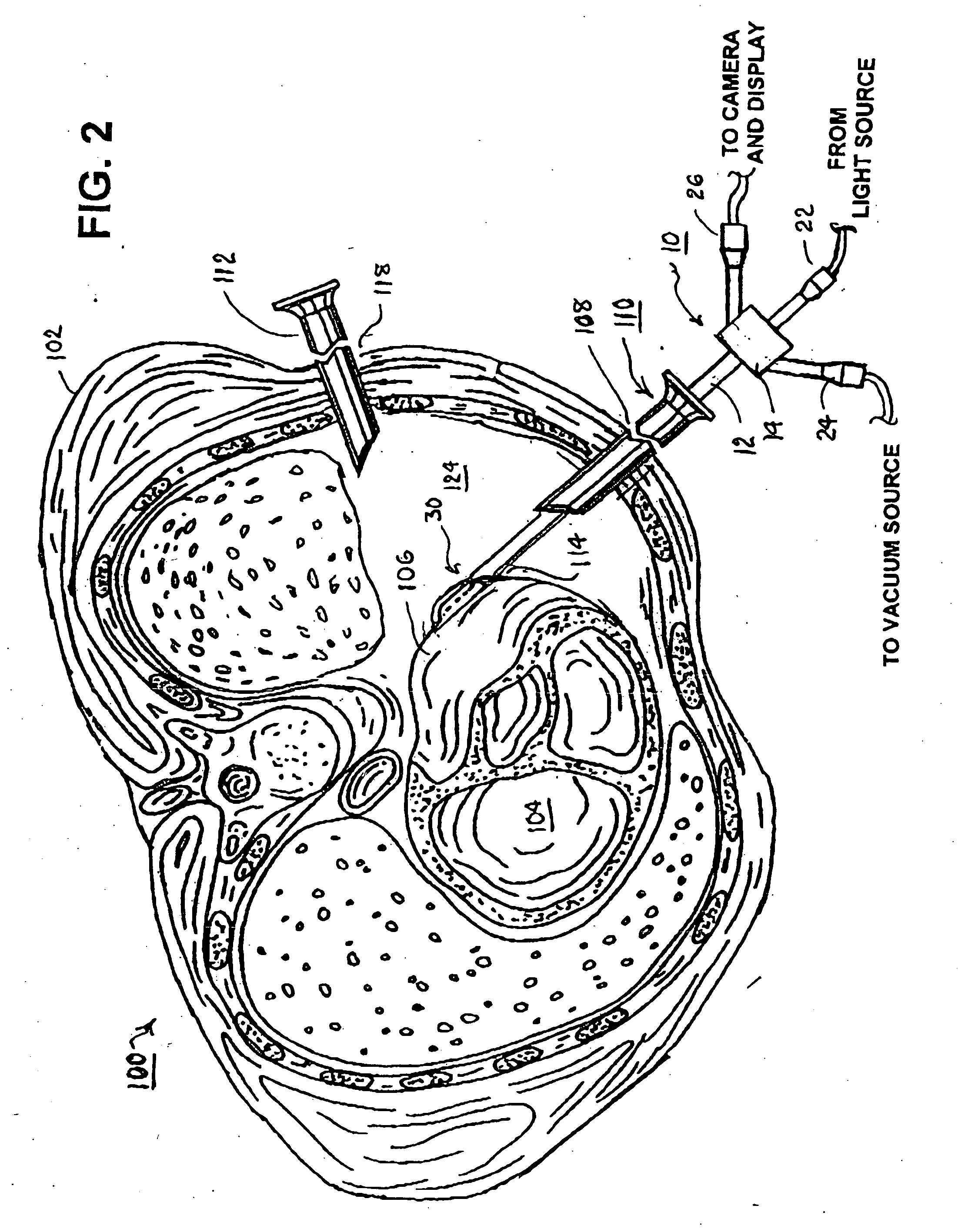 Methods and apparatus for accessing and stabilizing an area of the heart