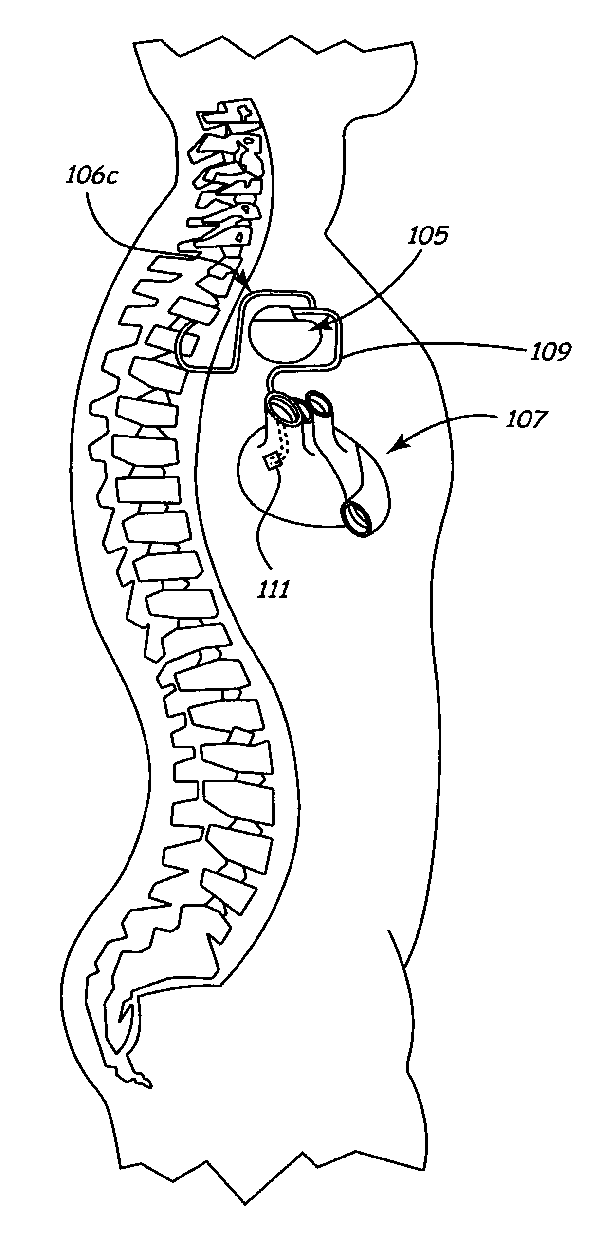 Method and apparatus for electrically stimulating the nervous system to improve ventricular dysfunction, heart failure, and other cardiac conditions